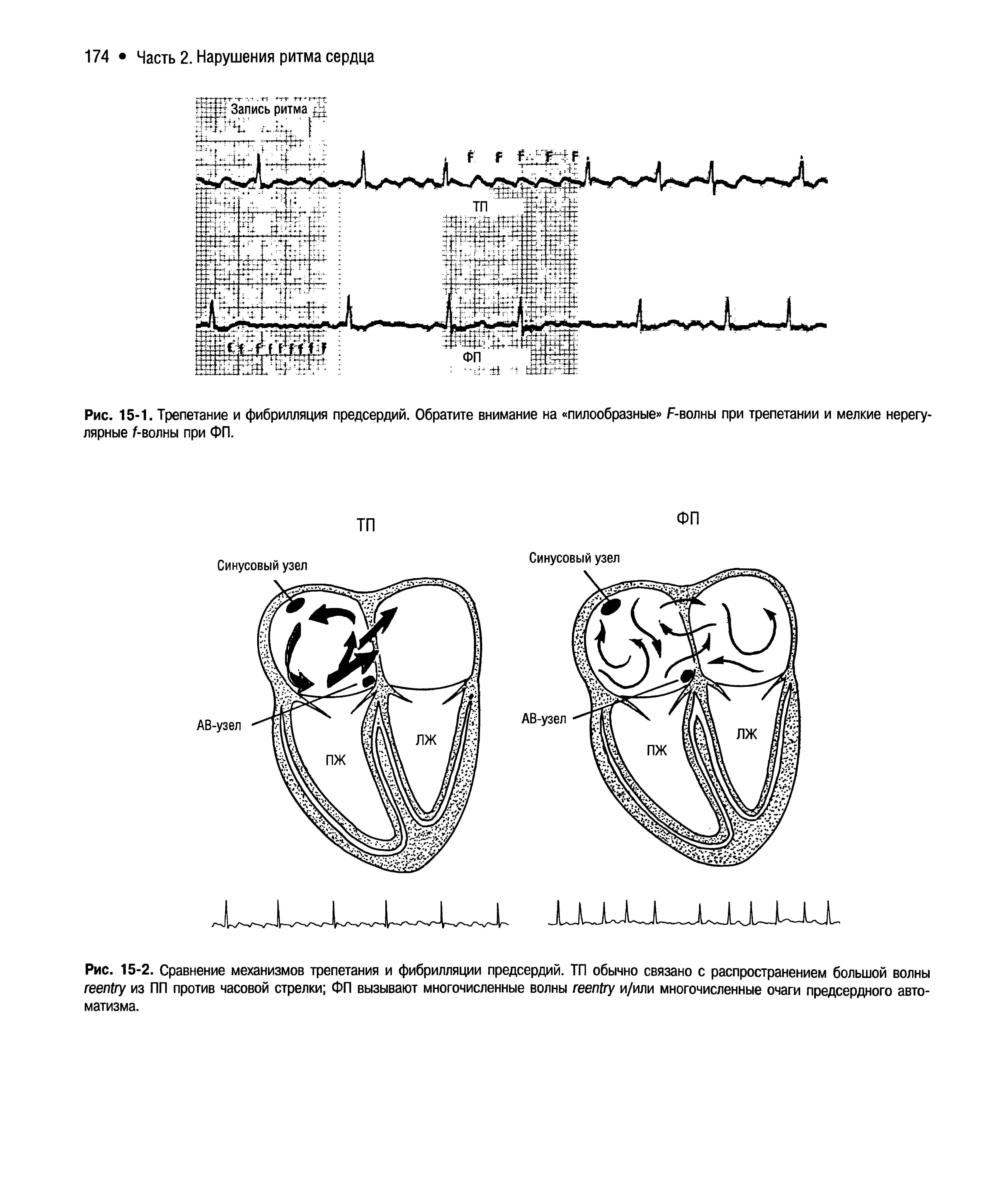 Рис. 15-2. Сравнение механизмов трепетания и фибрилляции предсердий. ТП обычно связано с распространением большой волны из ПП против часовой стрелки ФП вызывают многочисленные волны и/или многочисленные очаги предсердного автоматизма.