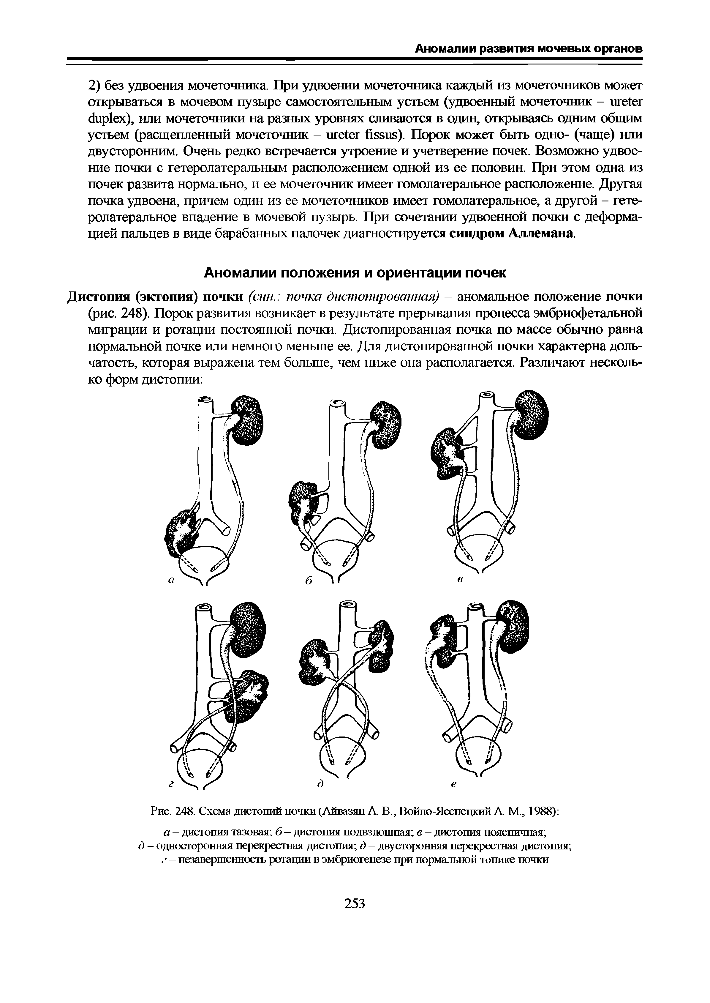 Рис. 248. Схема дистопий почки (Айвазян А. В., Войно-Ясенецкий А М., 1988) а — дистопия тазовая б- дистопия подвздошная в — дистопия поясничная ...
