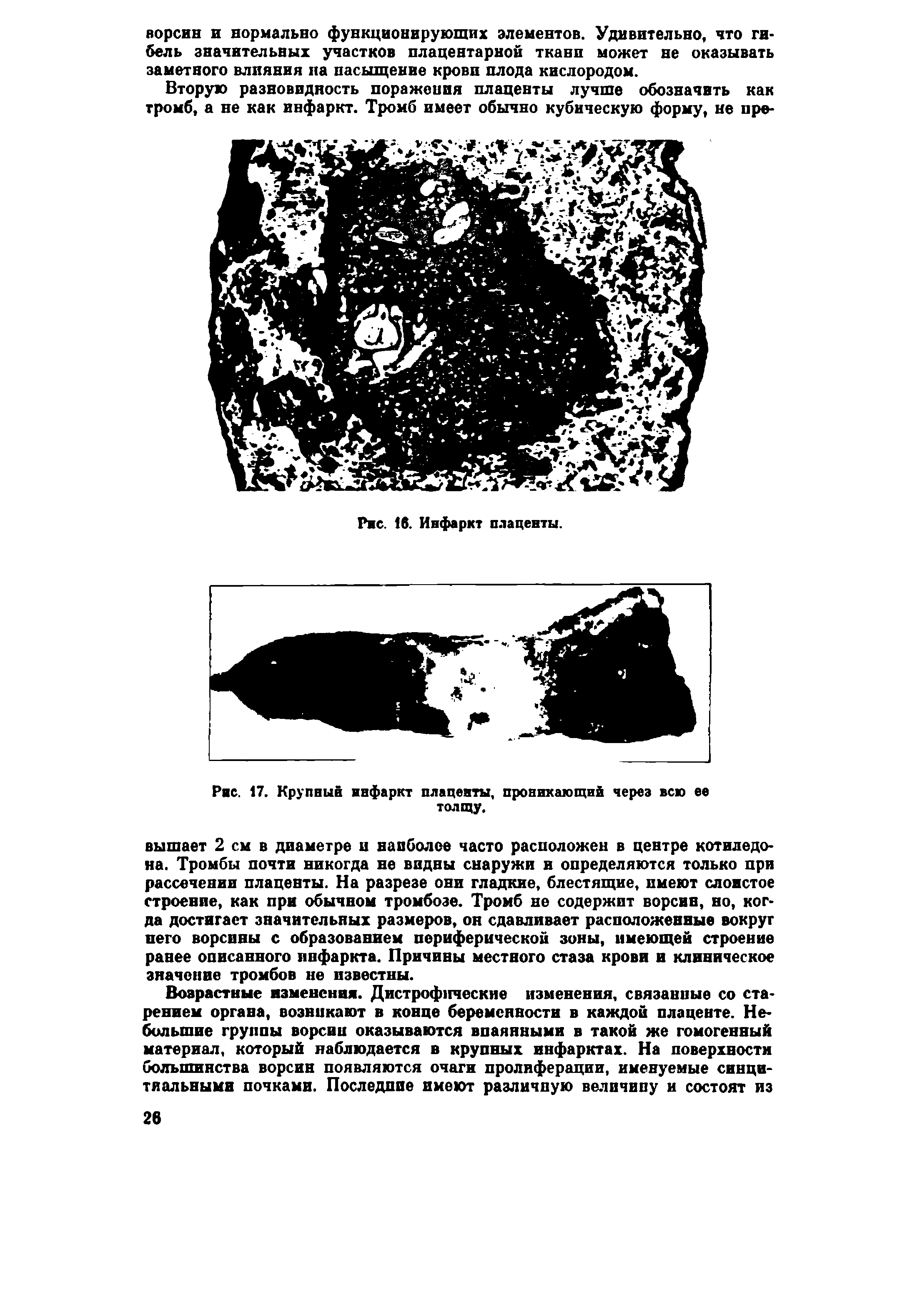 Рис. 17. Крупный инфаркт плаценты, проникающий через всю ее толщу.