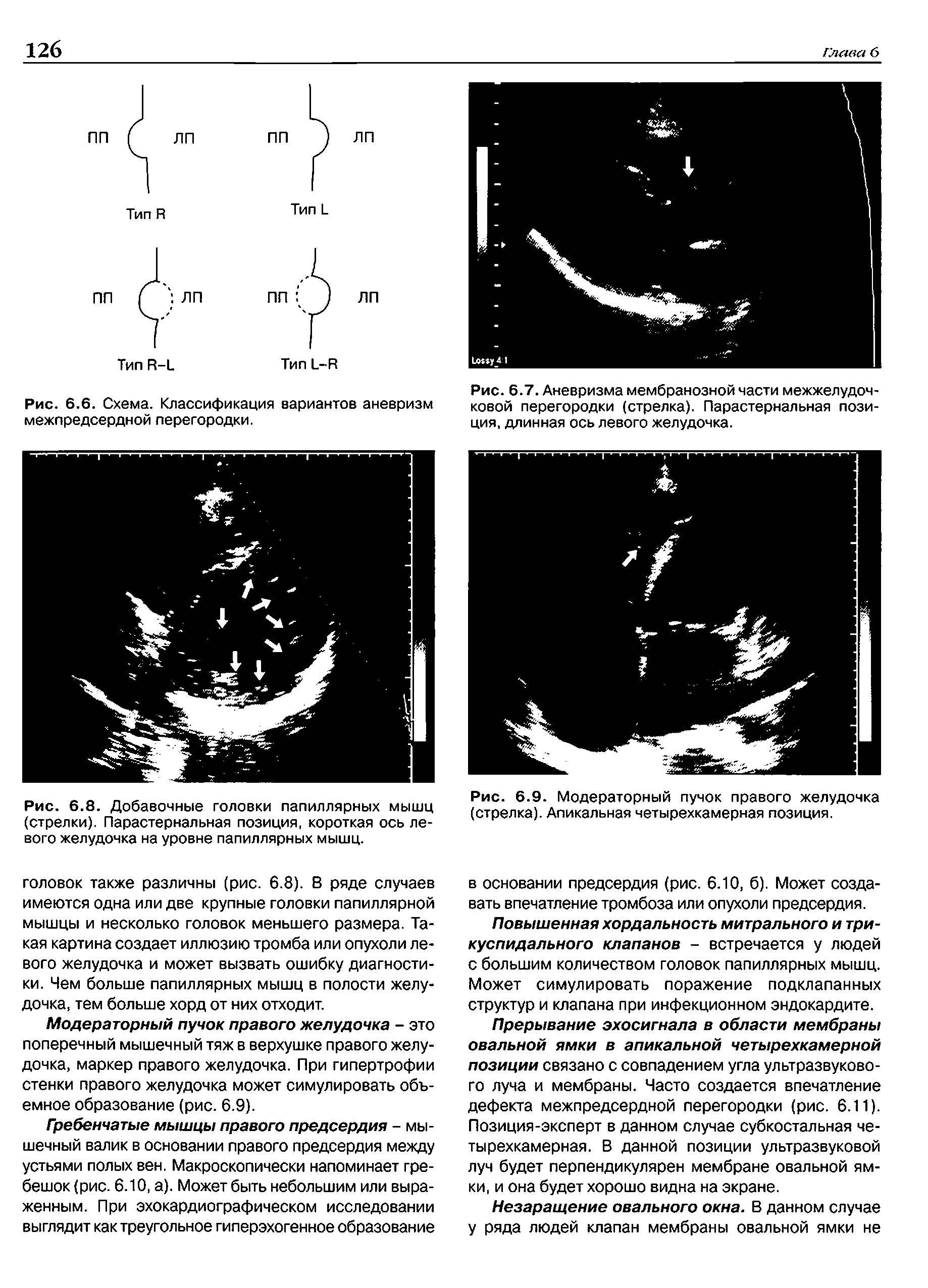 Рис. 6.7. Аневризма мембранозной части межжелудочковой перегородки (стрелка). Парастернальная позиция, длинная ось левого желудочка.