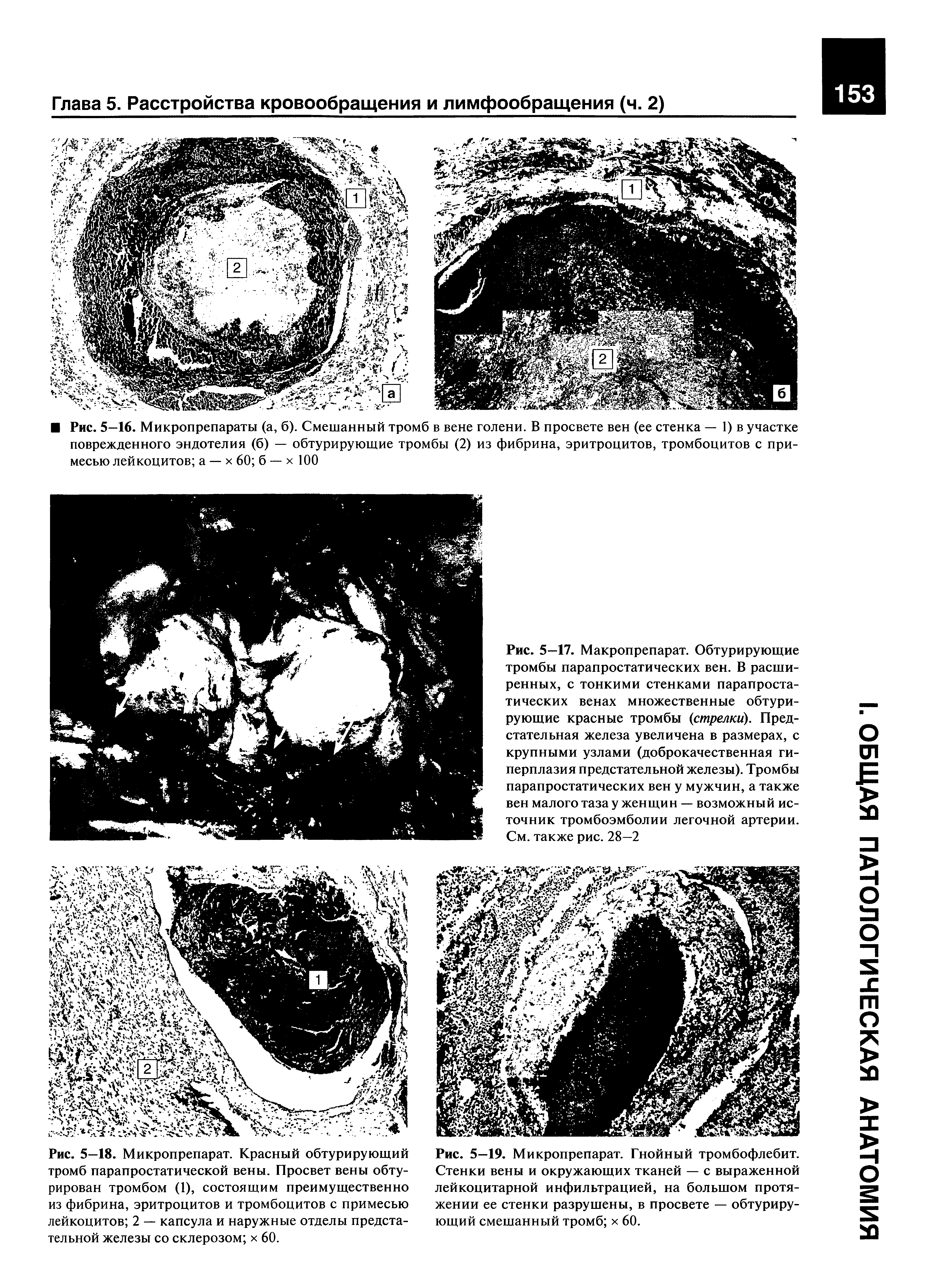 Рис. 5—18. Микропрепарат. Красный обтурирующий тромб парапростатической вены. Просвет вены обтурирован тромбом (1), состоящим преимущественно из фибрина, эритроцитов и тромбоцитов с примесью лейкоцитов 2 — капсула и наружные отделы предстательной железы со склерозом х 60.