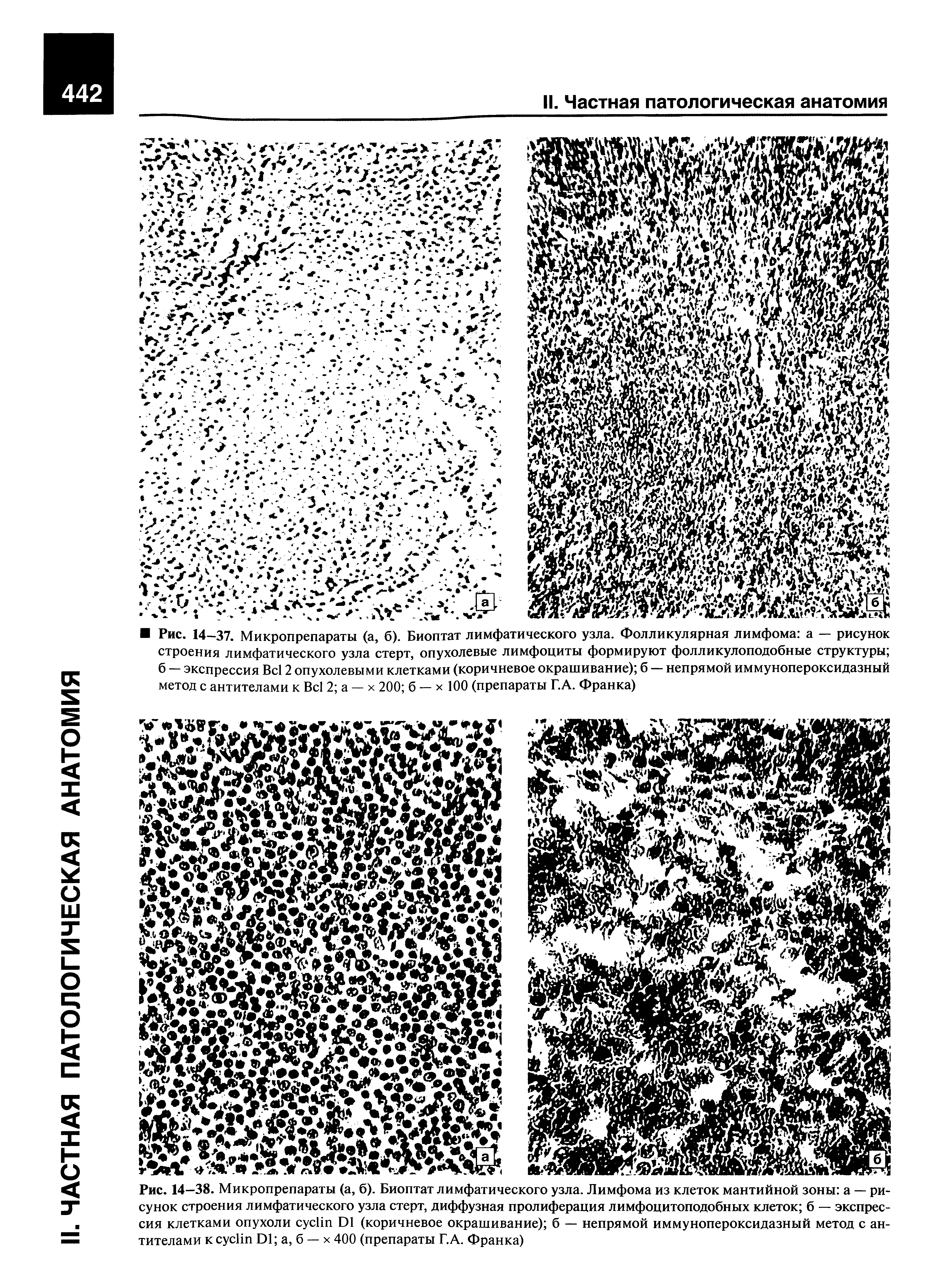 Рис. 14—38. Микропрепараты (а, б). Биоптат лимфатического узла. Лимфома из клеток мантийной зоны а — рисунок строения лимфатического узла стерт, диффузная пролиферация лимфоцитоподобных клеток б — экспрессия клетками опухоли сусНп Б1 (коричневое окрашивание) б — непрямой иммунопероксидазный метод с антителами к сусНп Г>1 а, б — х 400 (препараты Г.А. Франка)...