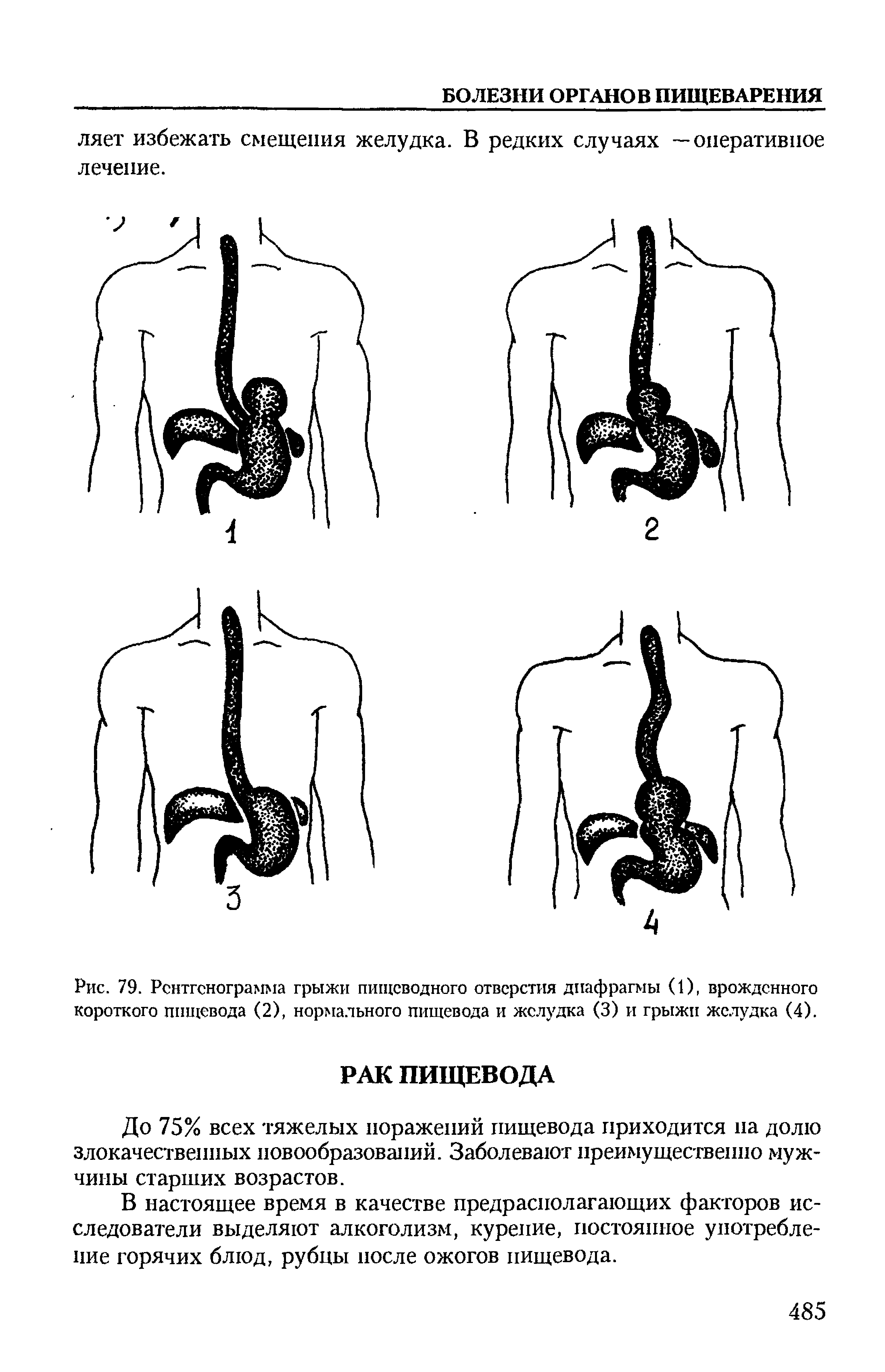 Рис. 79. Рентгенограмма грыжи пищеводного отверстия диафрагмы (1), врожденного короткого пищевода (2), нормального пищевода и желудка (3) и грыжи желудка (4).