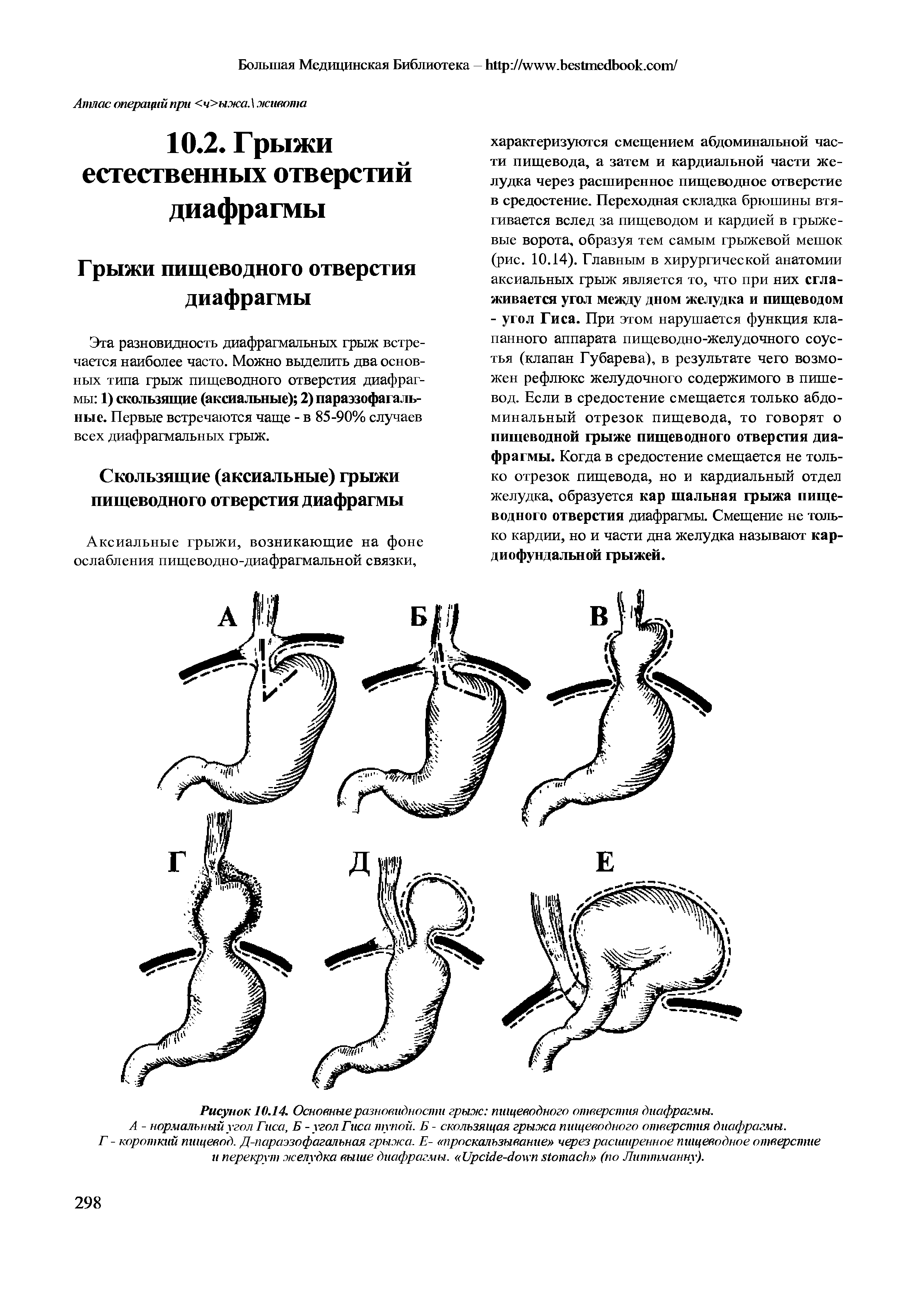 Рисунок 10.14. Основные разновидности грыж пищеводного отверстия диафрагмы.