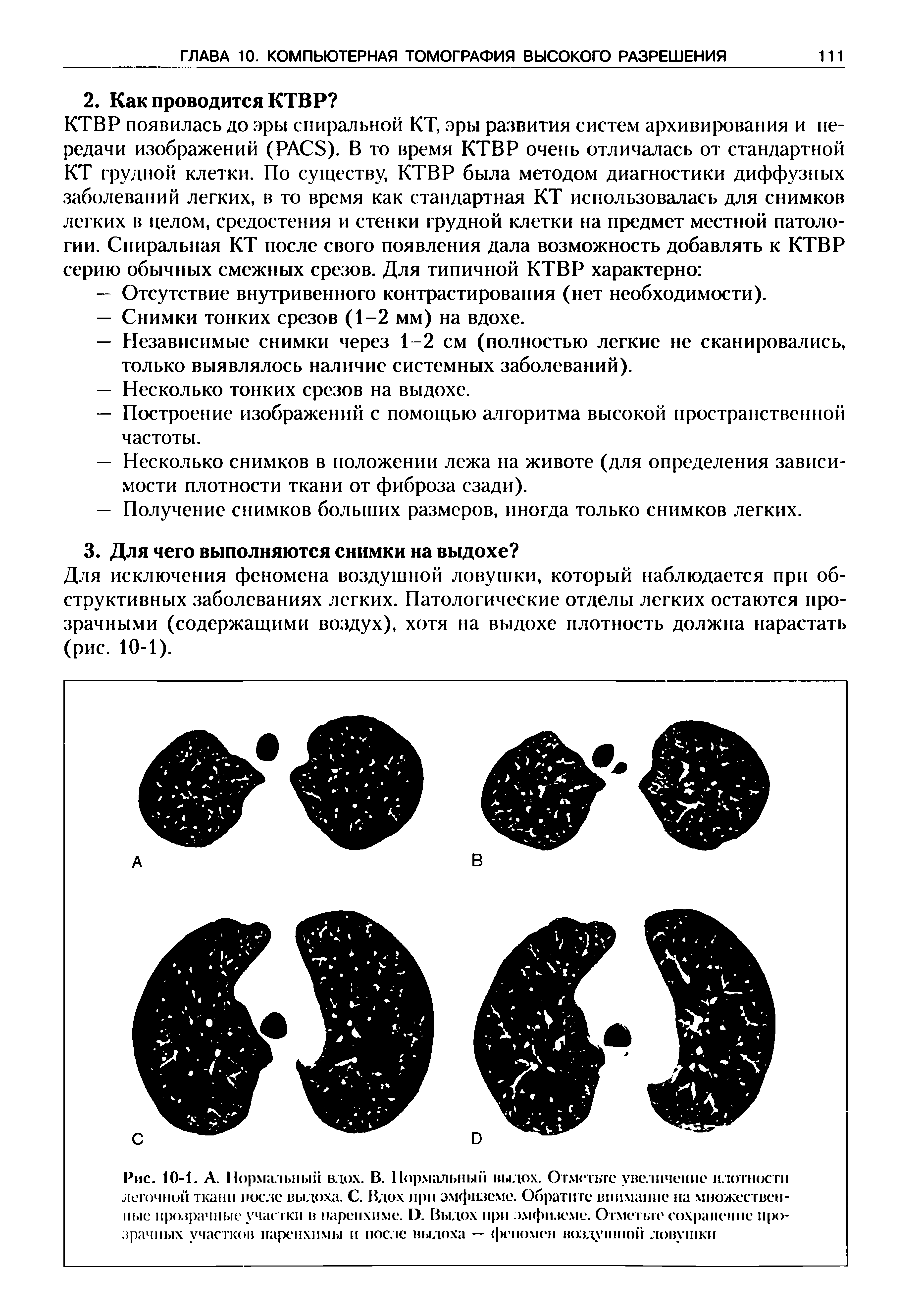 Рис. 10-1. А. Нормальный вдох. В. Нормальный выдох. Отметьте увеличение плотности легочной ткани после выдоха. С. Вдох при эмфиземе. Обратите внимание на множественные прозрачные участки в паренхиме. I). Выдох при эмфиземе. Отметьте сохранение прозрачных участков паренхимы и после выдоха — феномен воздушной ловушки...