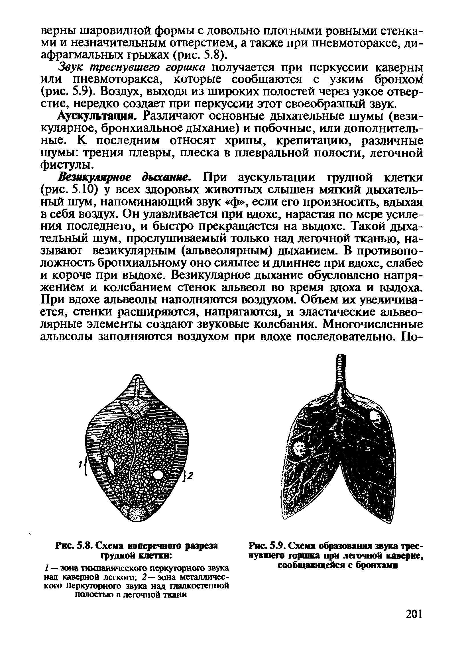 Рис. 5.9. Схема образования звука треснувшего горшка при легочной каверне, сообщающейся с бронхами...