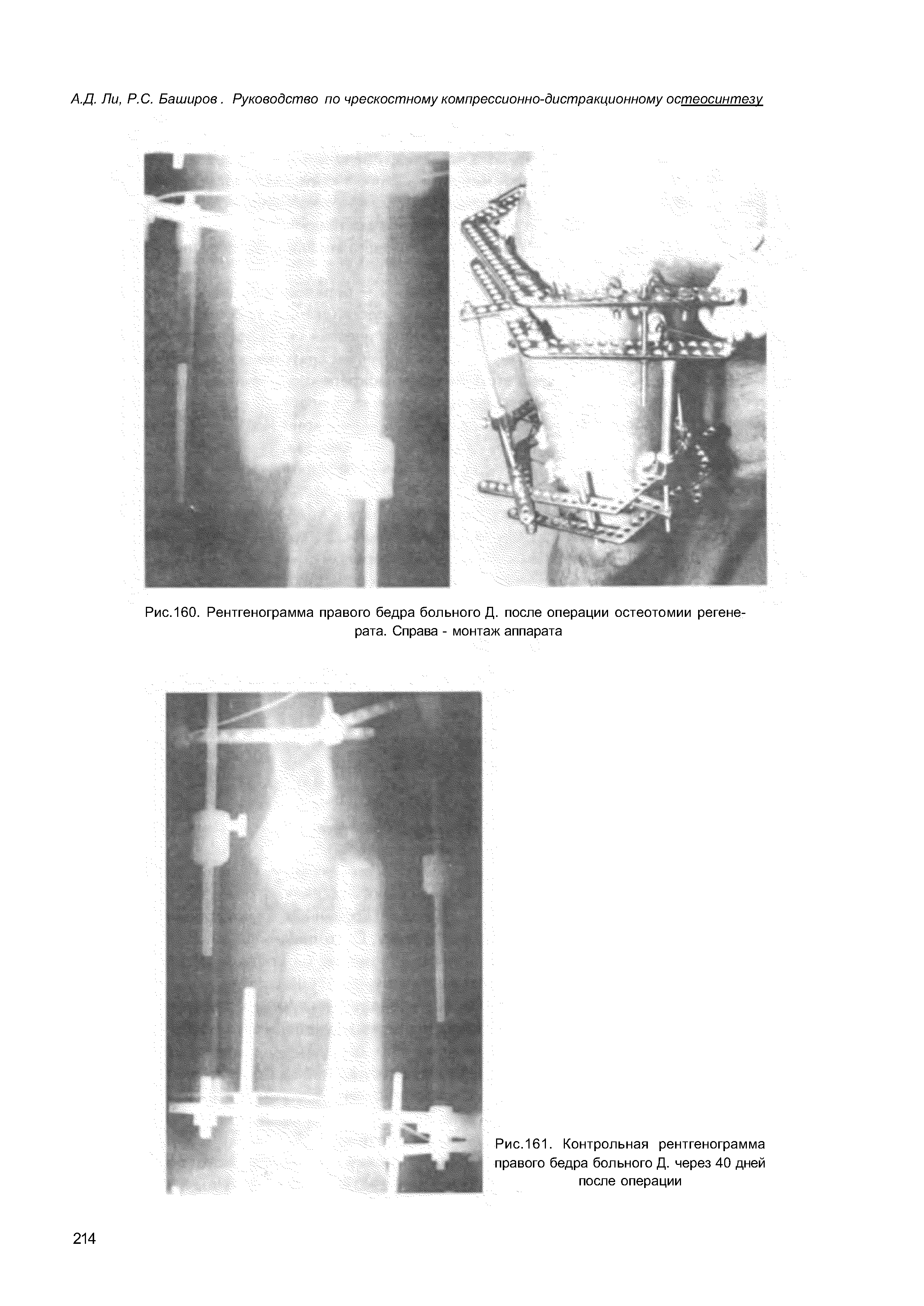 Рис.160. Рентгенограмма правого бедра больного Д. после операции остеотомии регенерата. Справа - монтаж аппарата...