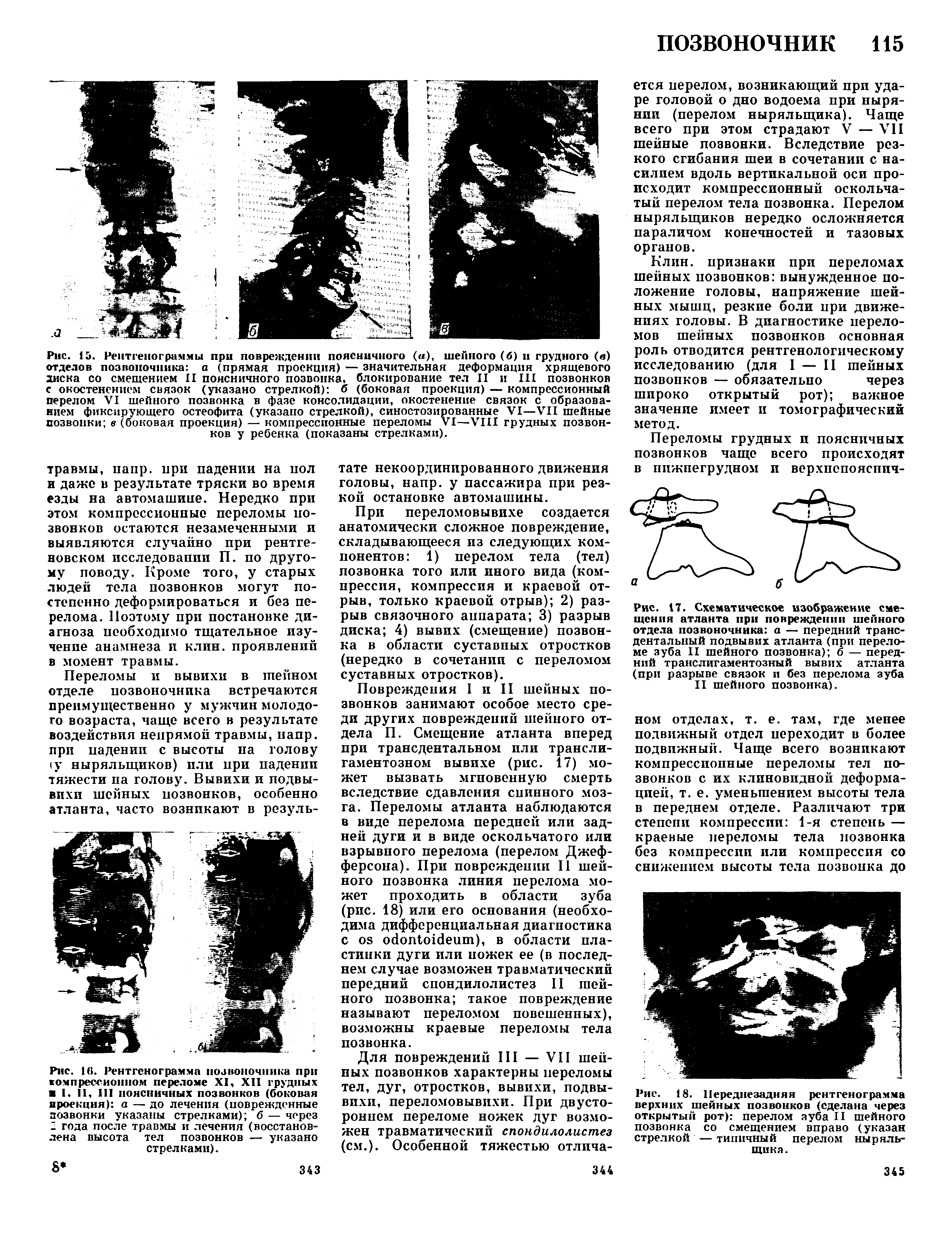 Рис. 18. Переднезадняя рентгенограмма верхних шейных позвонков (сделана через открытый рот) перелом зуба II шейного позвонка со смещением вправо (указан стрелкой — типичный перелом ныряльщика. ...