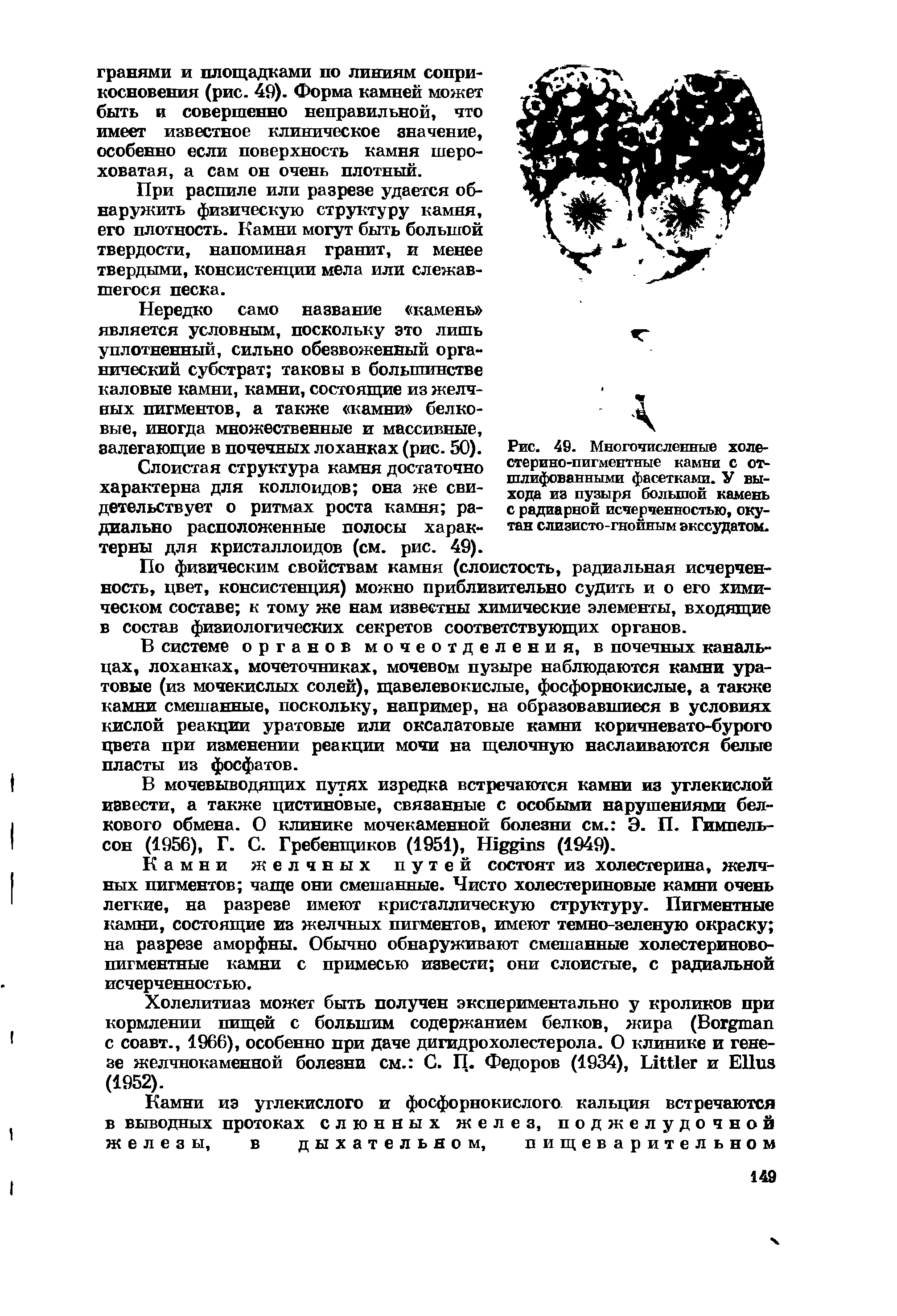 Рис. 49. Многочисленные холестерино-пигментные камни с отшлифованными фасетками. У выхода из пузыря большой камень с радиарной исчерченностью, окутан слизисто-гнойным экссудатом.