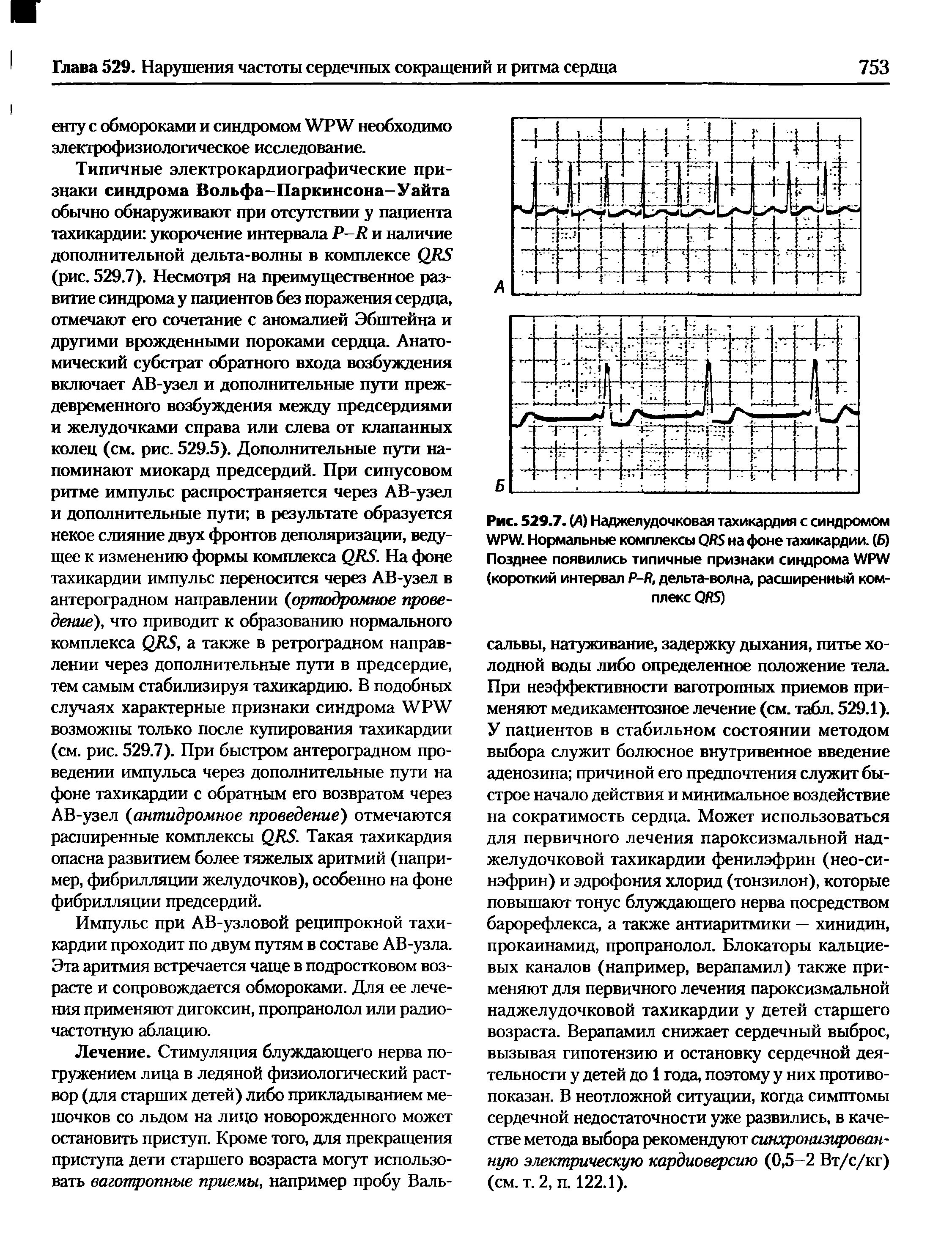 Рис. 529.7. (А) Наджелудочковая тахикардия с синдромом УУРУУ. Нормальные комплексы на фоне тахикардии. (Б) Позднее появились типичные признаки синдрома WPW (короткий интервал Р-Я, дельта-волна, расширенный комплекс (Ж)...