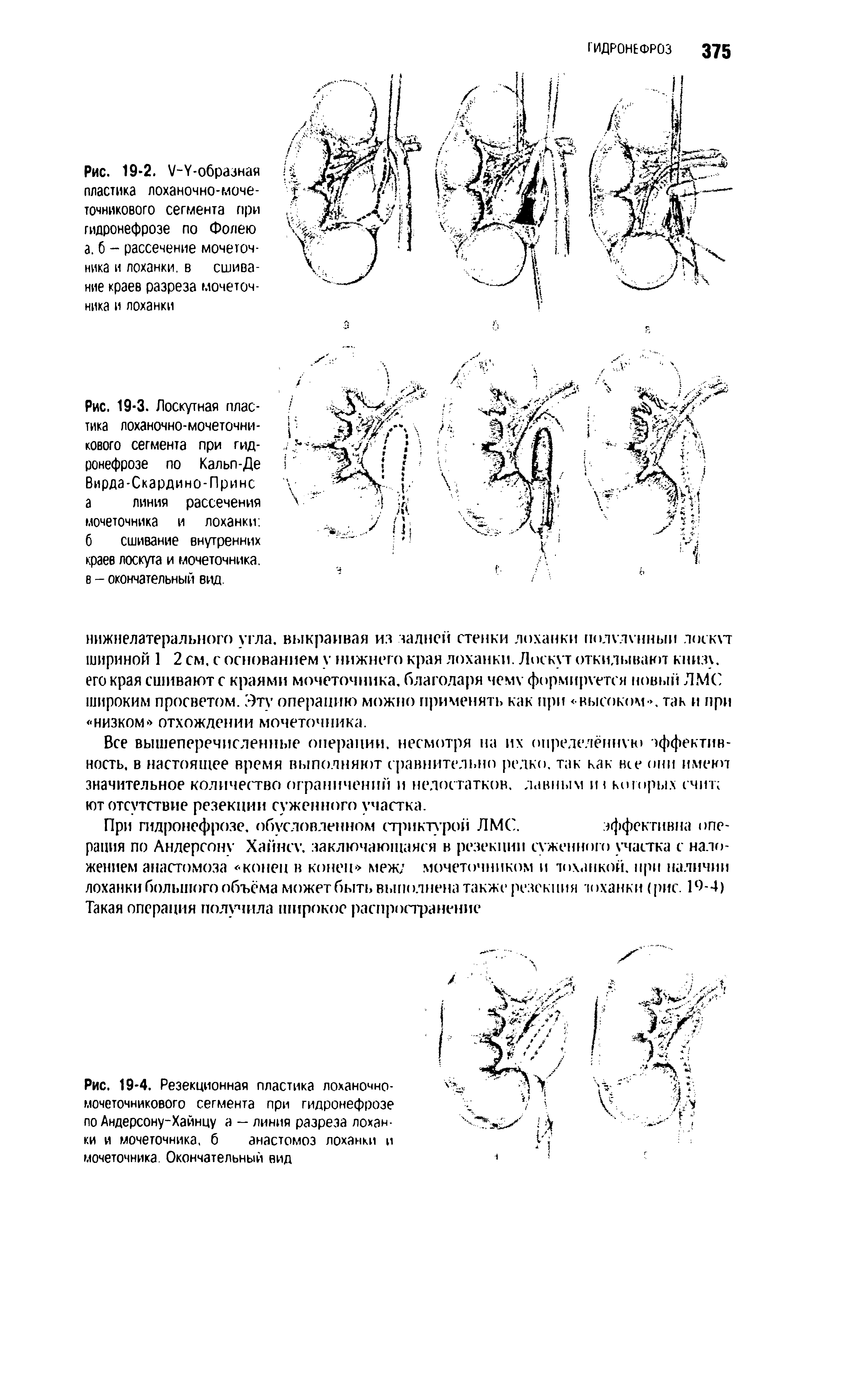 Рис. 19-4. Резекционная пластика лоханочно-мочеточникового сегмента при гидронефрозе по Андерсону-Хайнцу а — линия разреза лоханки и мочеточника, б анастомоз лоханки и мочеточника. Окончательный вид...