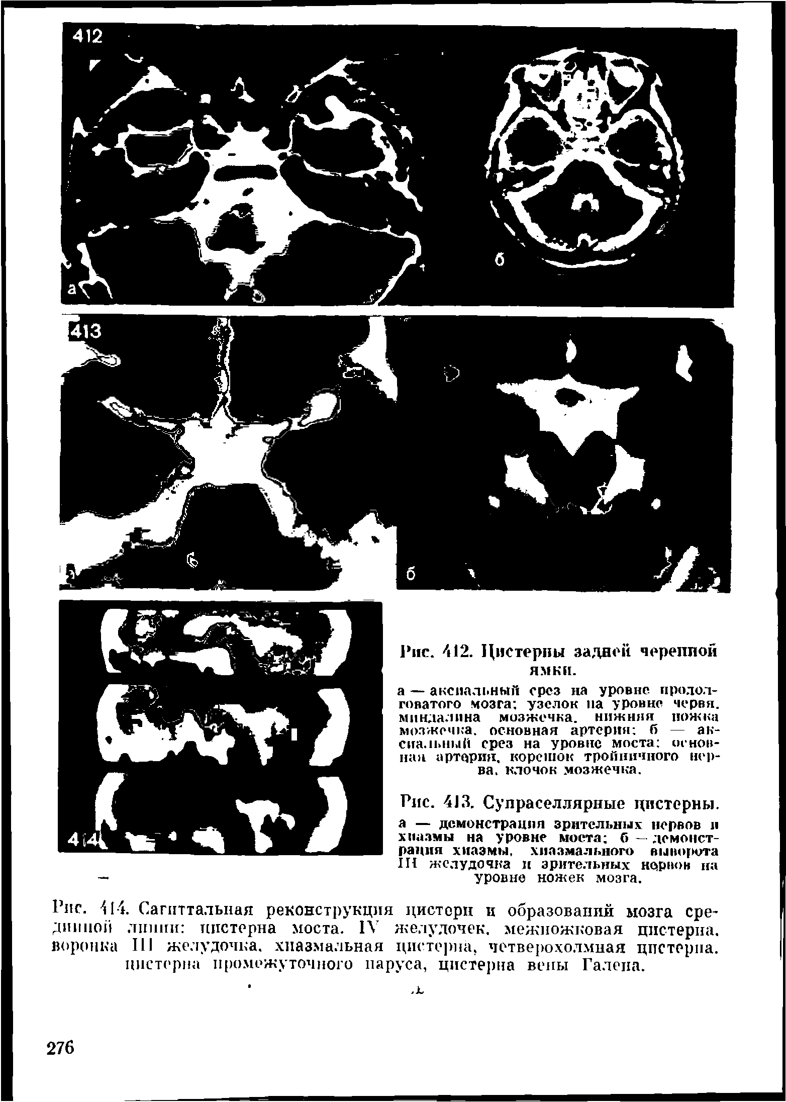 Рис. 414. Сагиттальная реконструкция цистерн и образований мозга срединной линии цистерна моста. IV желудочек, межножковая цистерна, воронка III желудочка, хиазмальная цистерна, четверохолмная цистерна, цистерна промежуточного паруса, цистерна вены Галена.