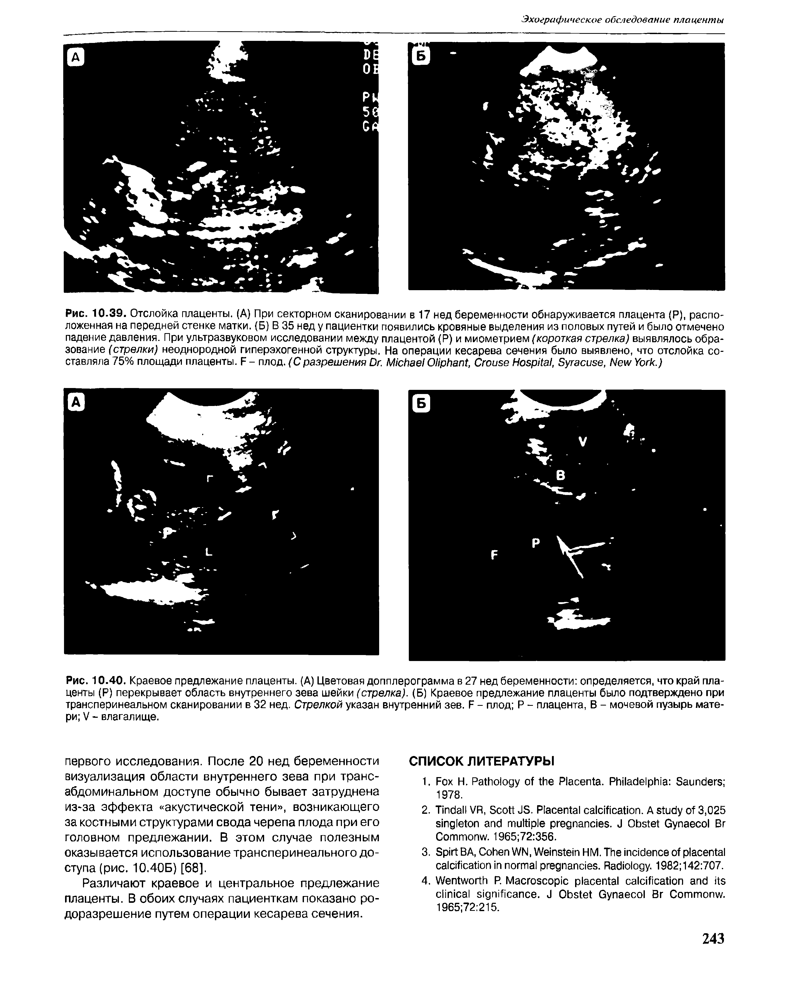 Рис. 10.40. Краевое предлежание плаценты. (А) Цветовая допплерограмма в 27 нед беременности определяется, что край плаценты (Р) перекрывает область внутреннего зева шейки (стрелка). (Б) Краевое предлежание плаценты было подтверждено при трансперинеальном сканировании в 32 нед. Стрелкой указан внутренний зев. Б - плод Р - плацента, В - мочевой пузырь матери V - влагалище.