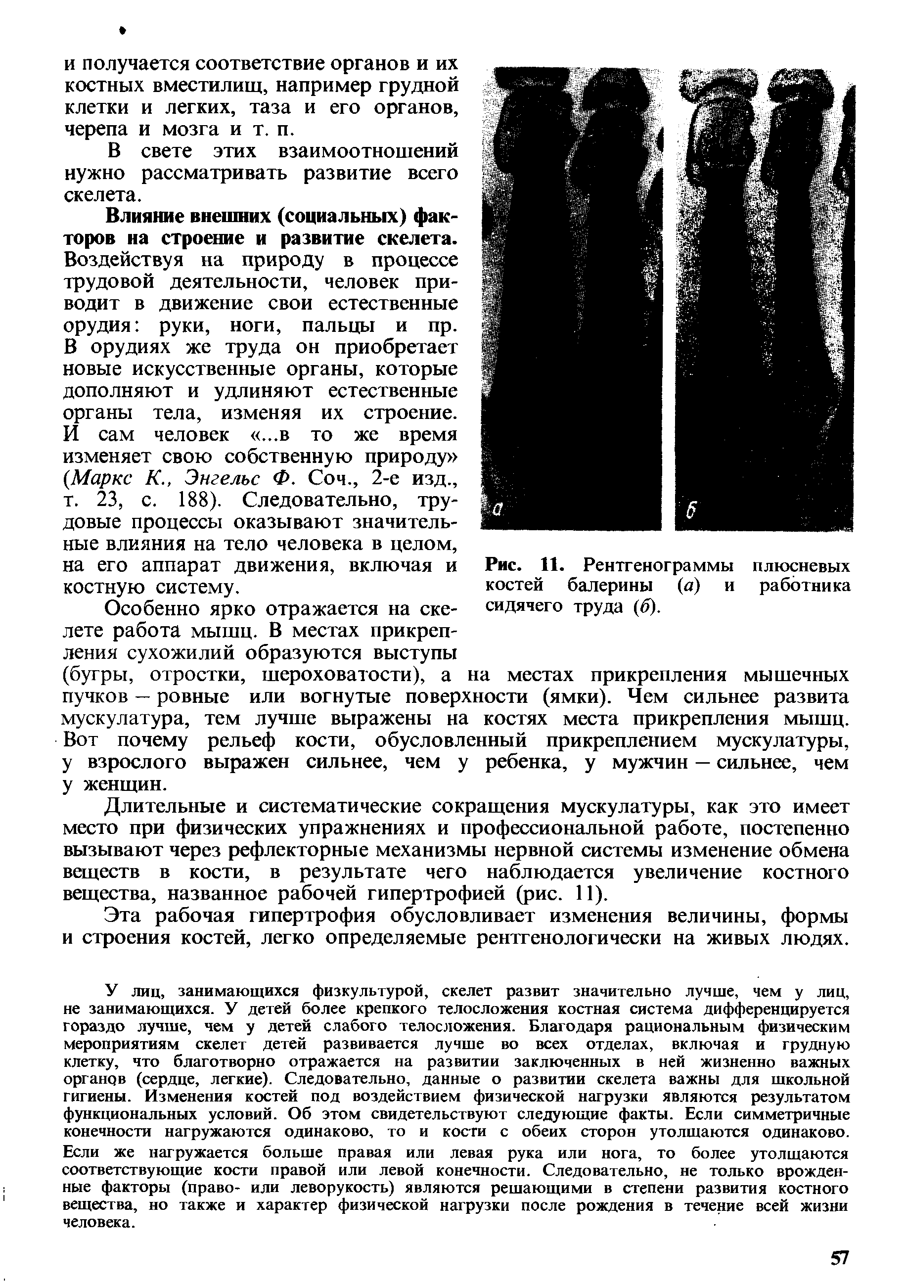 Рис. 11. Рентгенограммы плюсневых костей балерины (а) и работника сидячего труда (б).