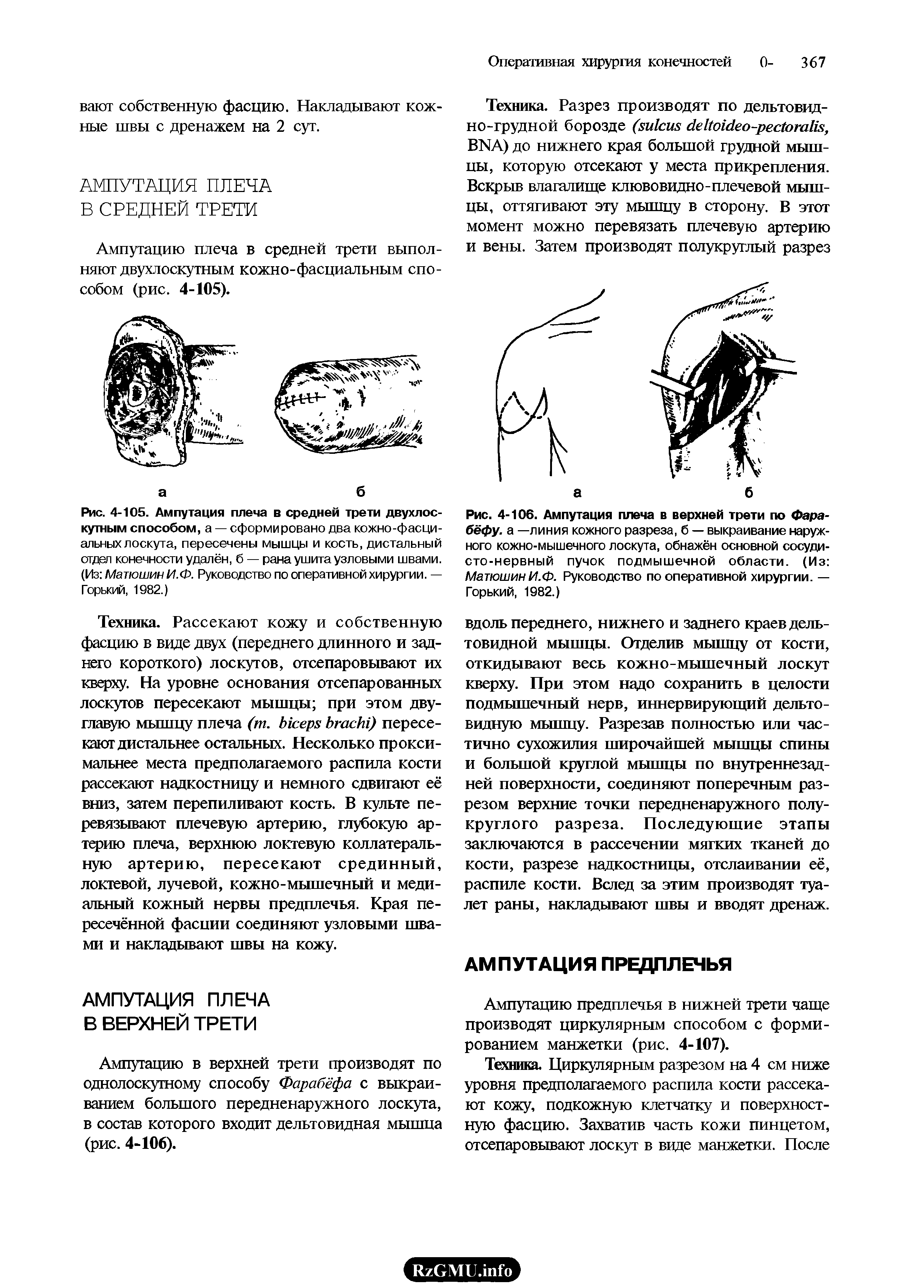 Рис. 4-106. Ампутация плеча в верхней трети по Фарабефу. а —линия кожного разреза, б — выкраивание наружного кожно-мышечного лоскута, обнажён основной сосудисто-нервный пучок подмышечной области. (Из МатюшинИ.Ф. Руководство по оперативной хирургии. — Горький, 1982.)...