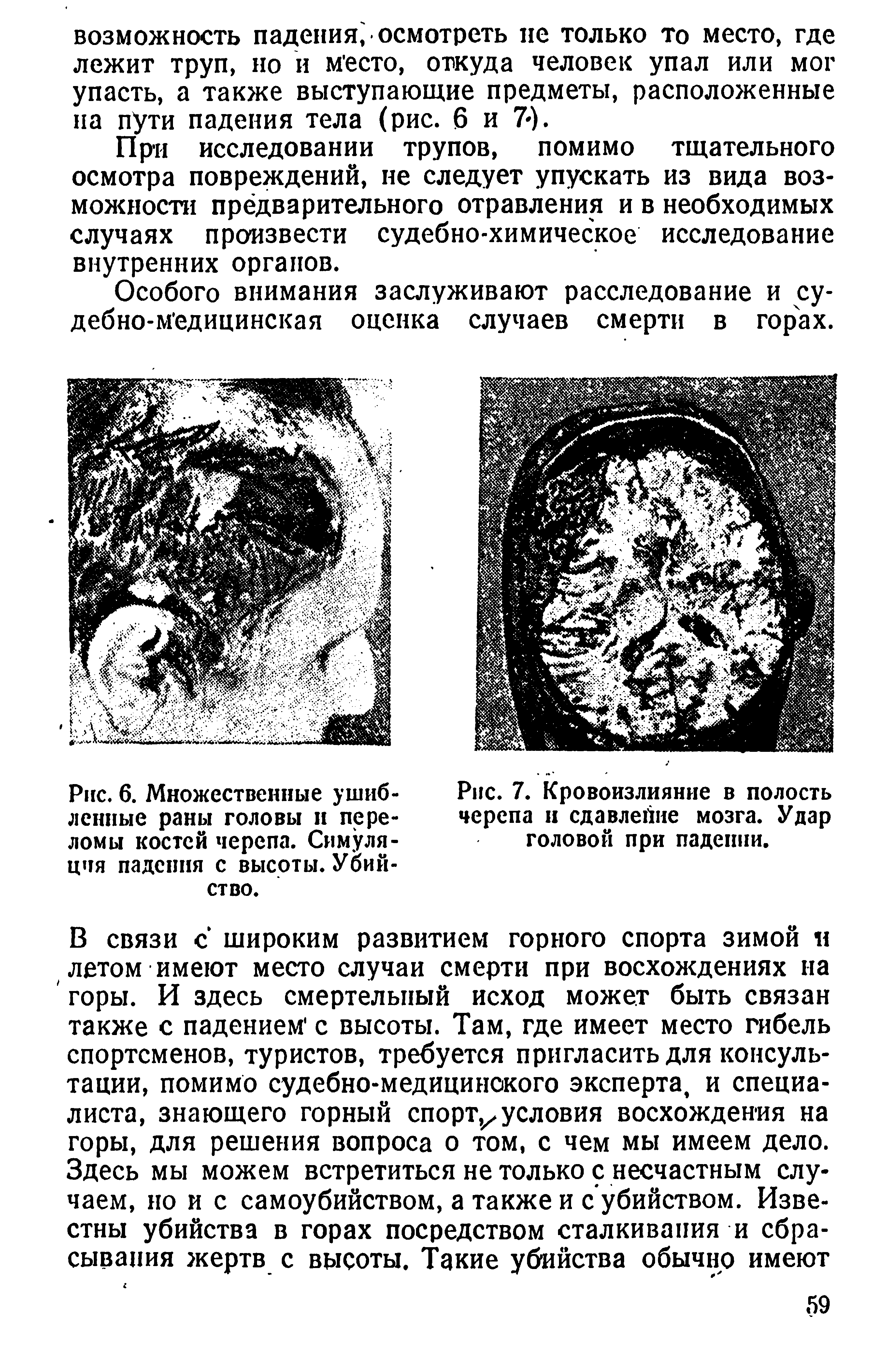 Рис. 6. Множественные ушибленные раны головы н переломы костей черепа. Симуляция падения с высоты. Убийство.