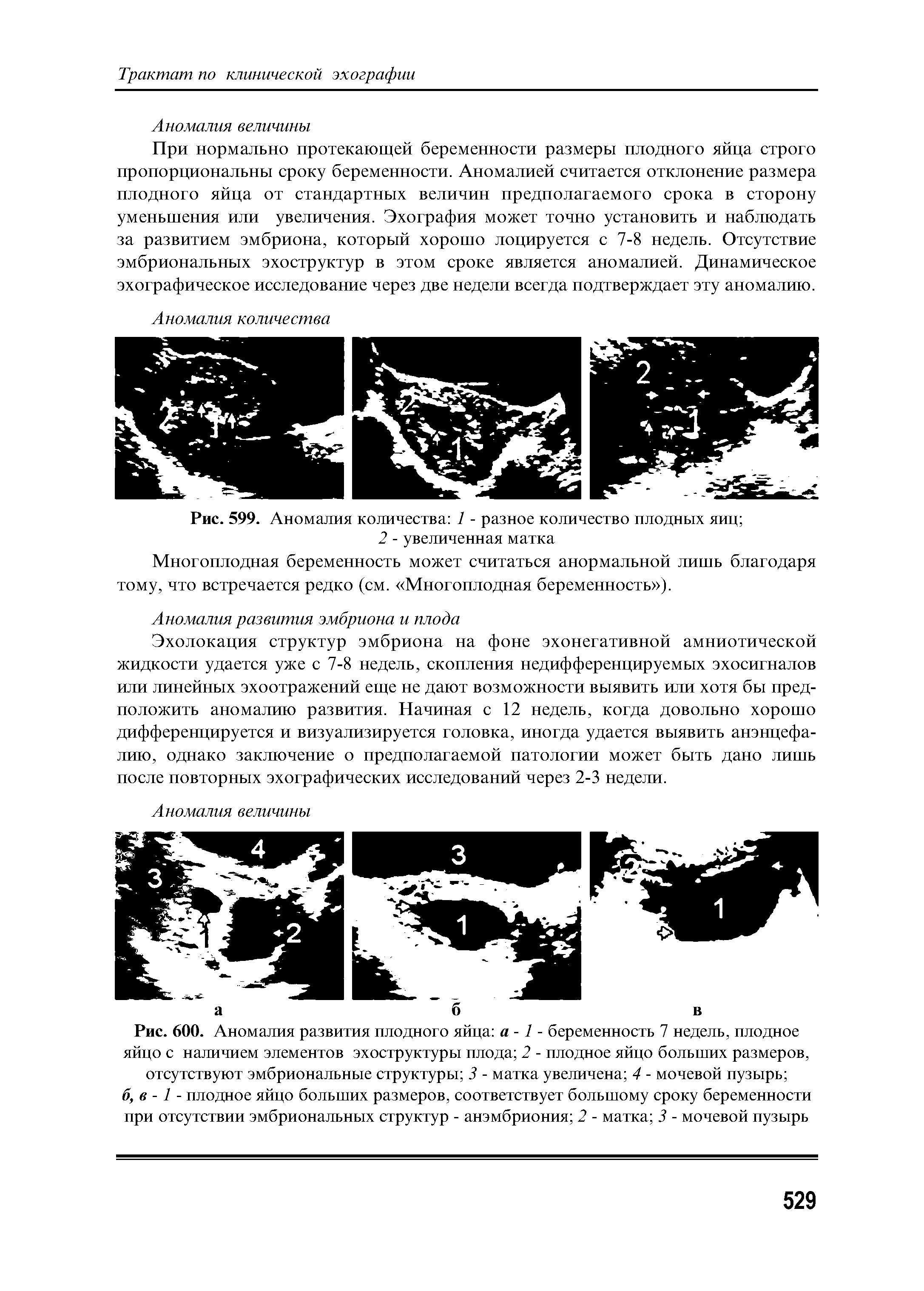 Рис. 600. Аномалия развития плодного яйца а -1 - беременность 7 недель, плодное яйцо с наличием элементов эхоструктуры плода 2 - плодное яйцо больших размеров, отсутствуют эмбриональные структуры 3 - матка увеличена 4 - мочевой пузырь ...