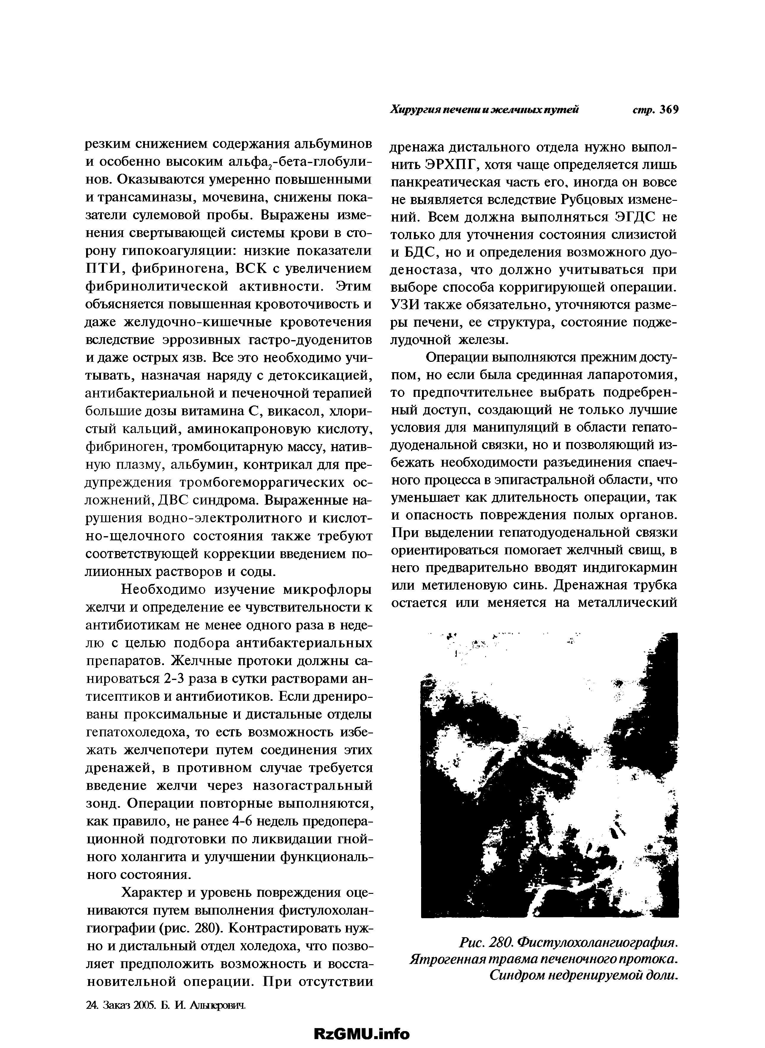 Рис. 280. Фистулохолангиография. Ятрогенная травма печеночного протока. Синдром недренируемой доли.