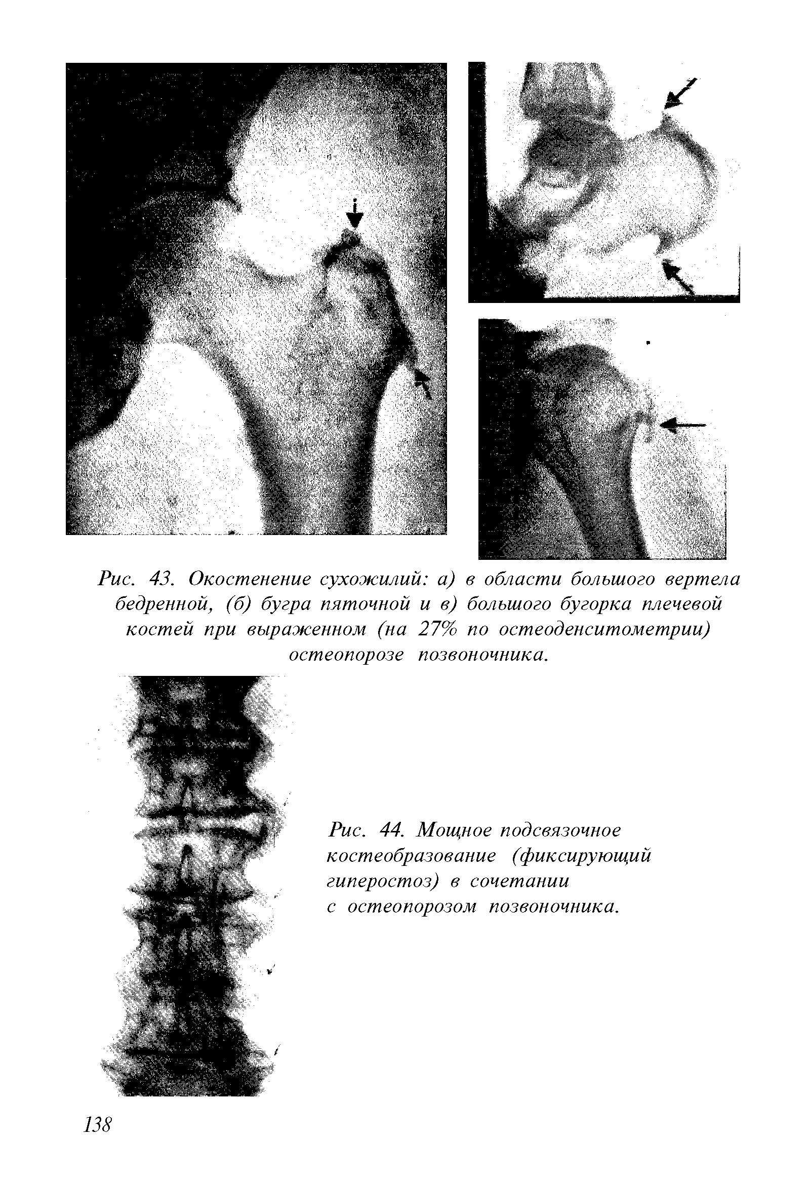 Рис. 44. Мощное подсвязочное костеобразование (фиксирующий гиперостоз) в сочетании с остеопорозом позвоночника.