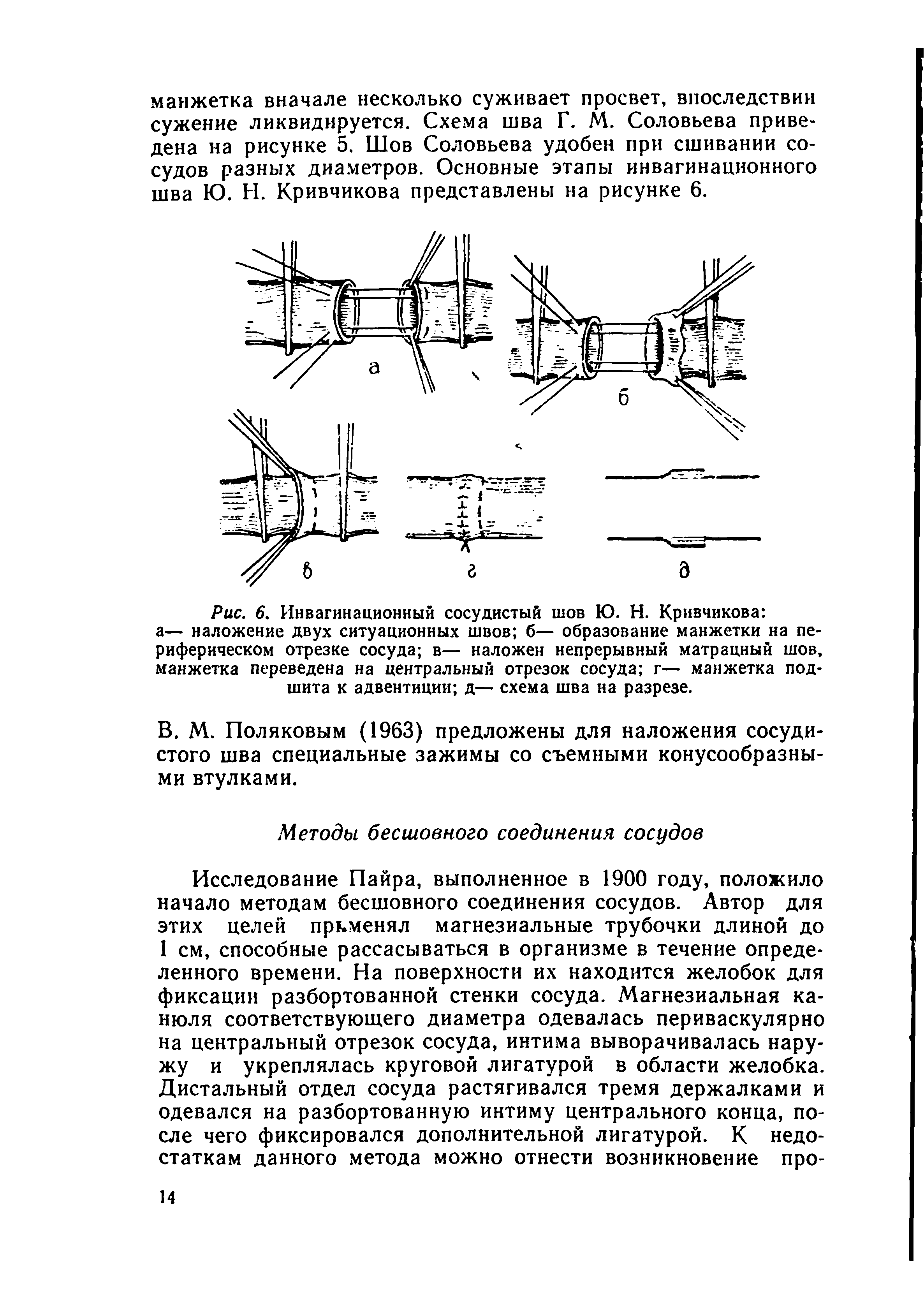 Рис. 6. Инвагинационный сосудистый шов Ю. Н. Кривчикова а— наложение двух ситуационных швов б— образование манжетки на периферическом отрезке сосуда в— наложен непрерывный матрацный шов, манжетка переведена на центральный отрезок сосуда г— манжетка подшита к адвентиции д— схема шва на разрезе.