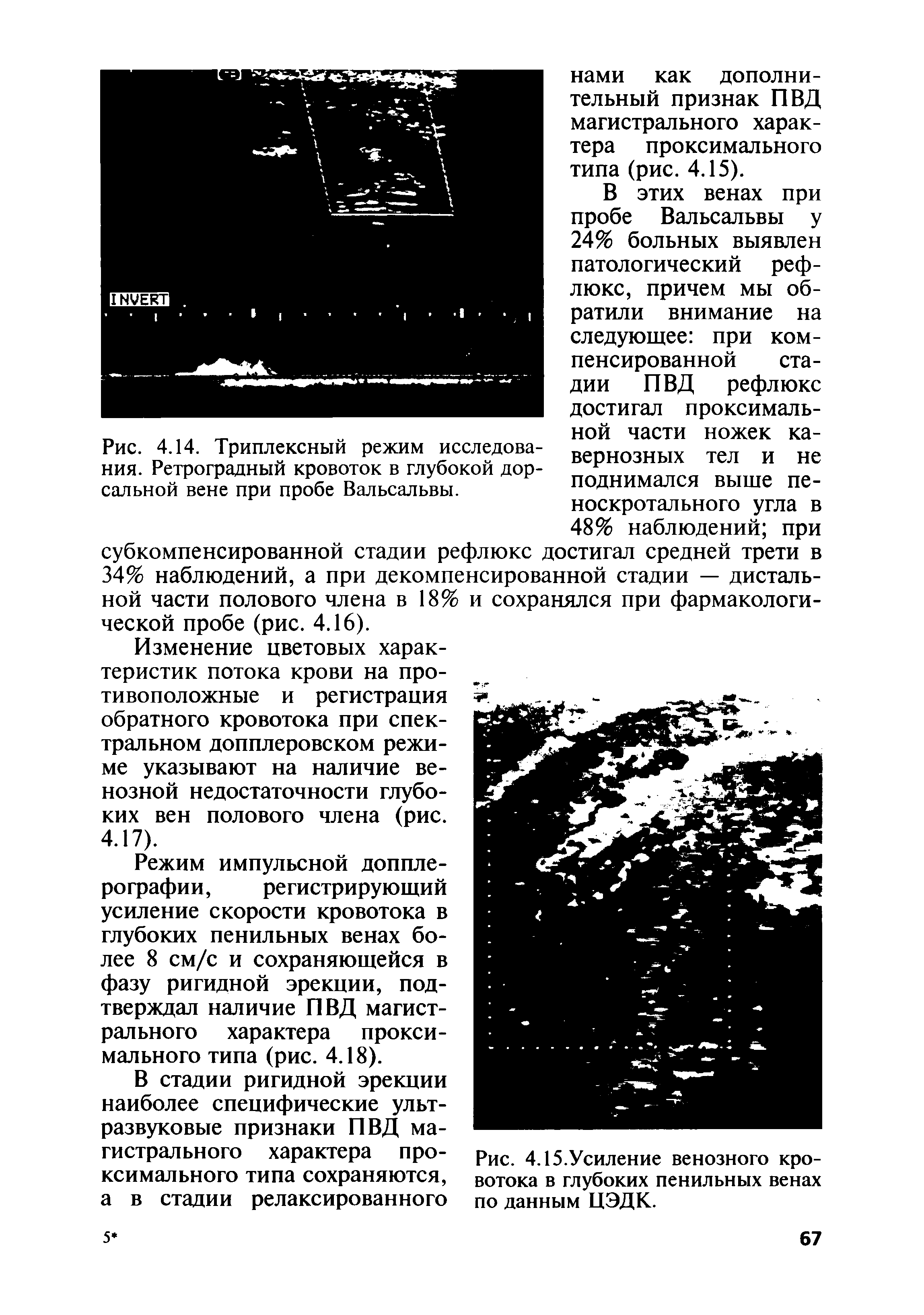 Рис. 4.14. Триплексный режим исследования. Ретроградный кровоток в глубокой дорсальной вене при пробе Вальсальвы. ной части ножек кавернозных тел и не поднимался выше пеноскротального угла в 48% наблюдений при...