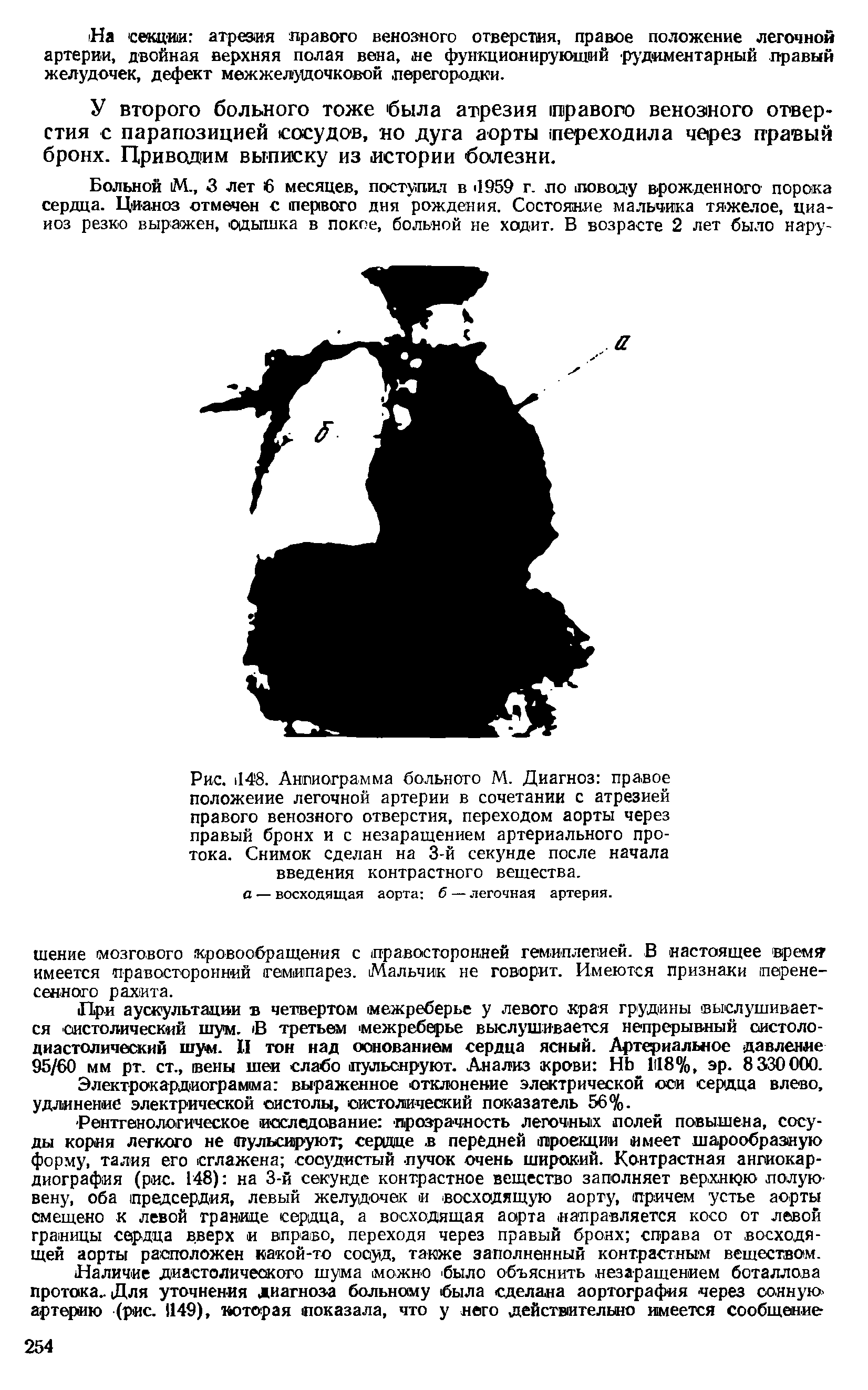 Рис. 148. Ангиограмма больного М. Диагноз правое положение легочной артерии в сочетании с атрезией правого венозного отверстия, переходом аорты через правый бронх и с незаращением артериального протока. Снимок сделан на 3-й секунде после начала введения контрастного вещества.