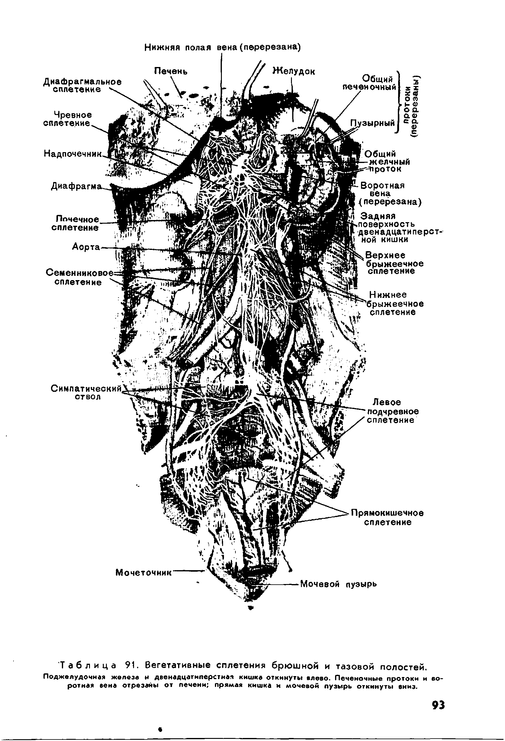 Таблица 91. Вегетативные сплетения брюшной и тазовой полостей. Поджелудочная железе и двенадцатиперстная кишка откинуты влево. Печеночные протоки и воротная вена отрезаны от печени прямая кишка и мочевой пузырь откинуты вниз.