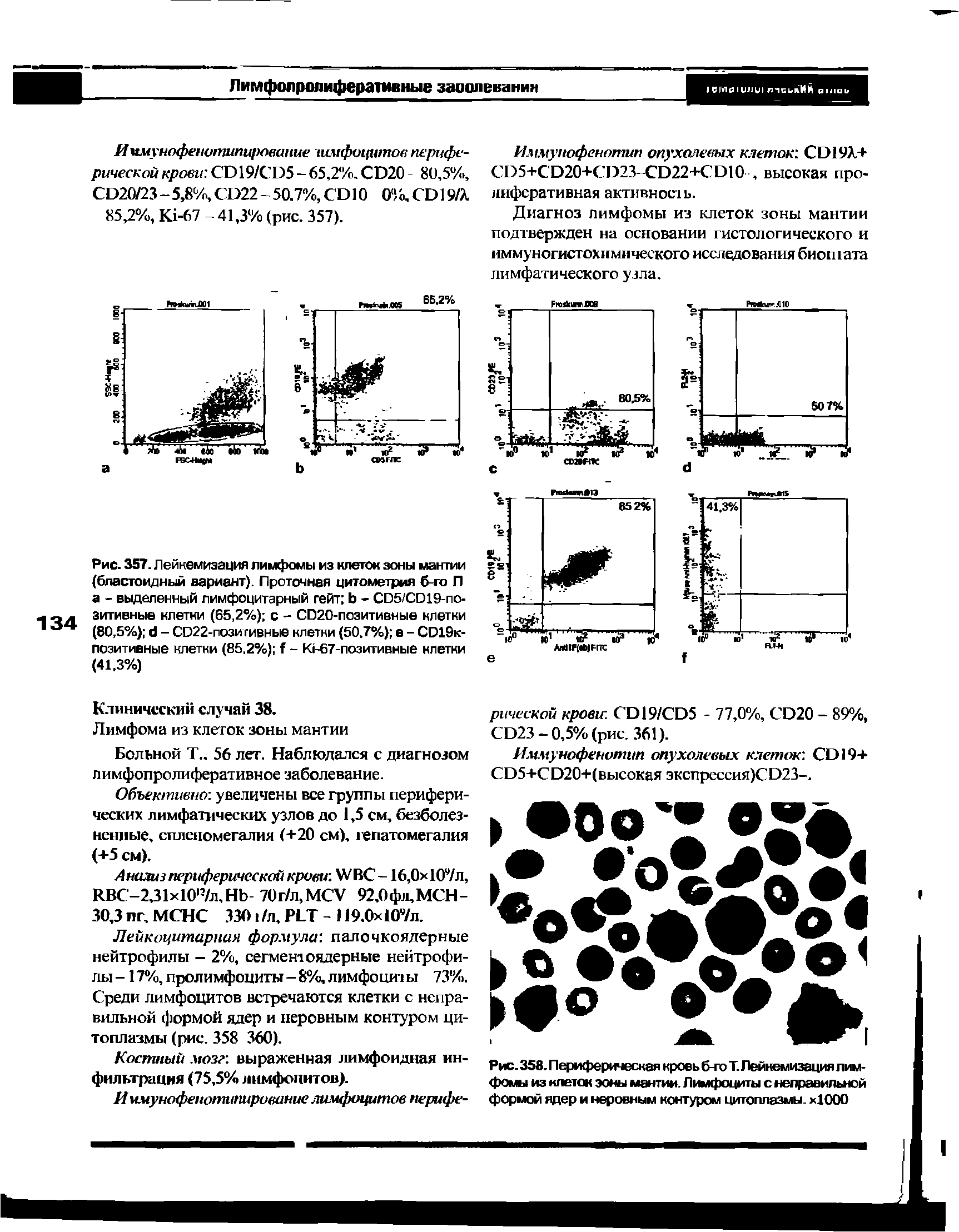 Рис. 357. Лейкемизация лимфомы из клеток зоны мантии (бластомдный вариант). Проточная цитометрия б-го П а - выделенный лимфоцитарный гейт Ь - СО5/СО19-по-1ЧД зитивные клетки (65,2%) с - С020-позитивные клетки 1 (80,5%) (1 - СО22-позитивные клетки (50,7%) е - СО19к-...