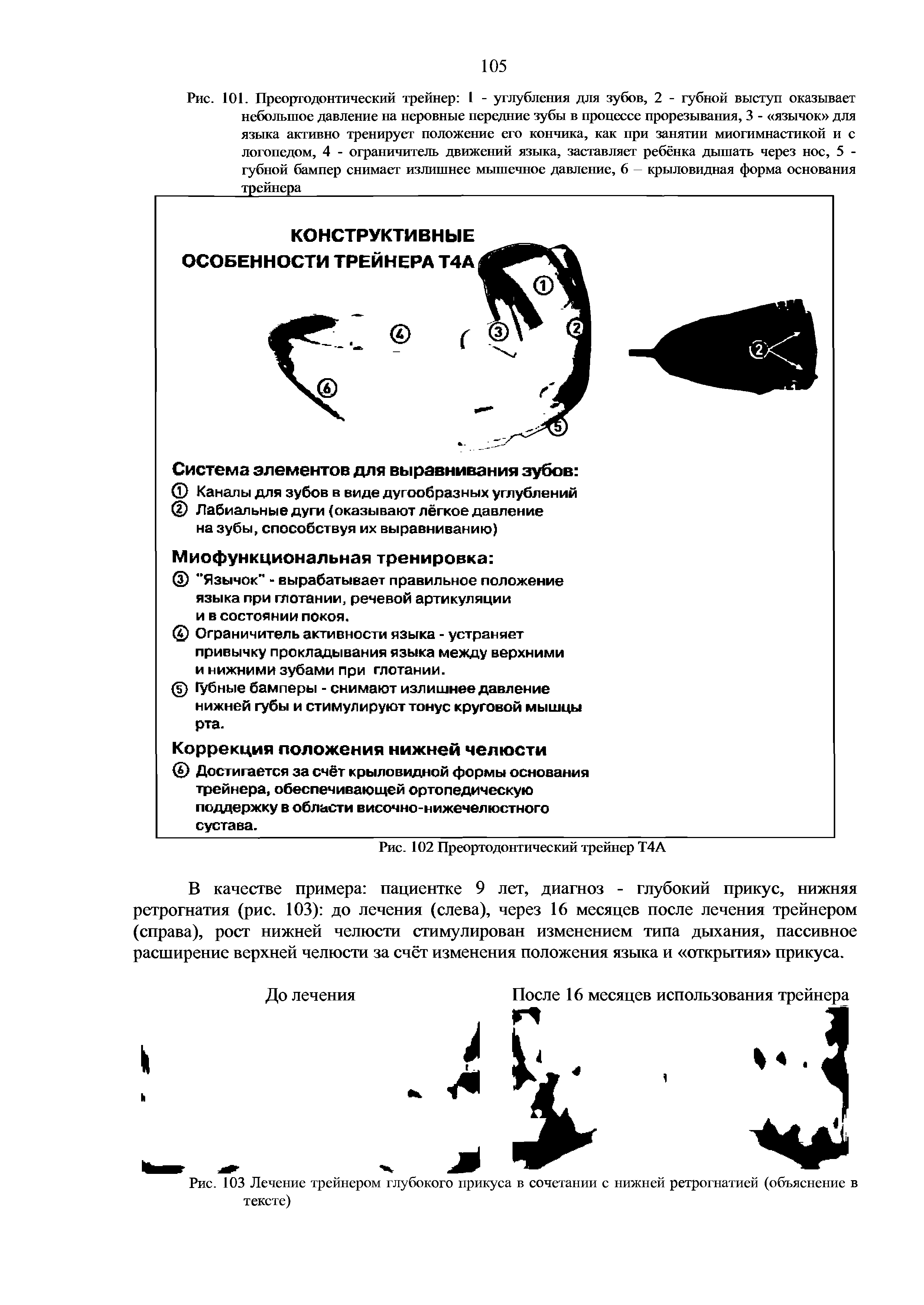 Рис. 103 Лечение трейнером глубокого прикуса в сочетании с нижней ретрогнатией (объяснение в тексте)...
