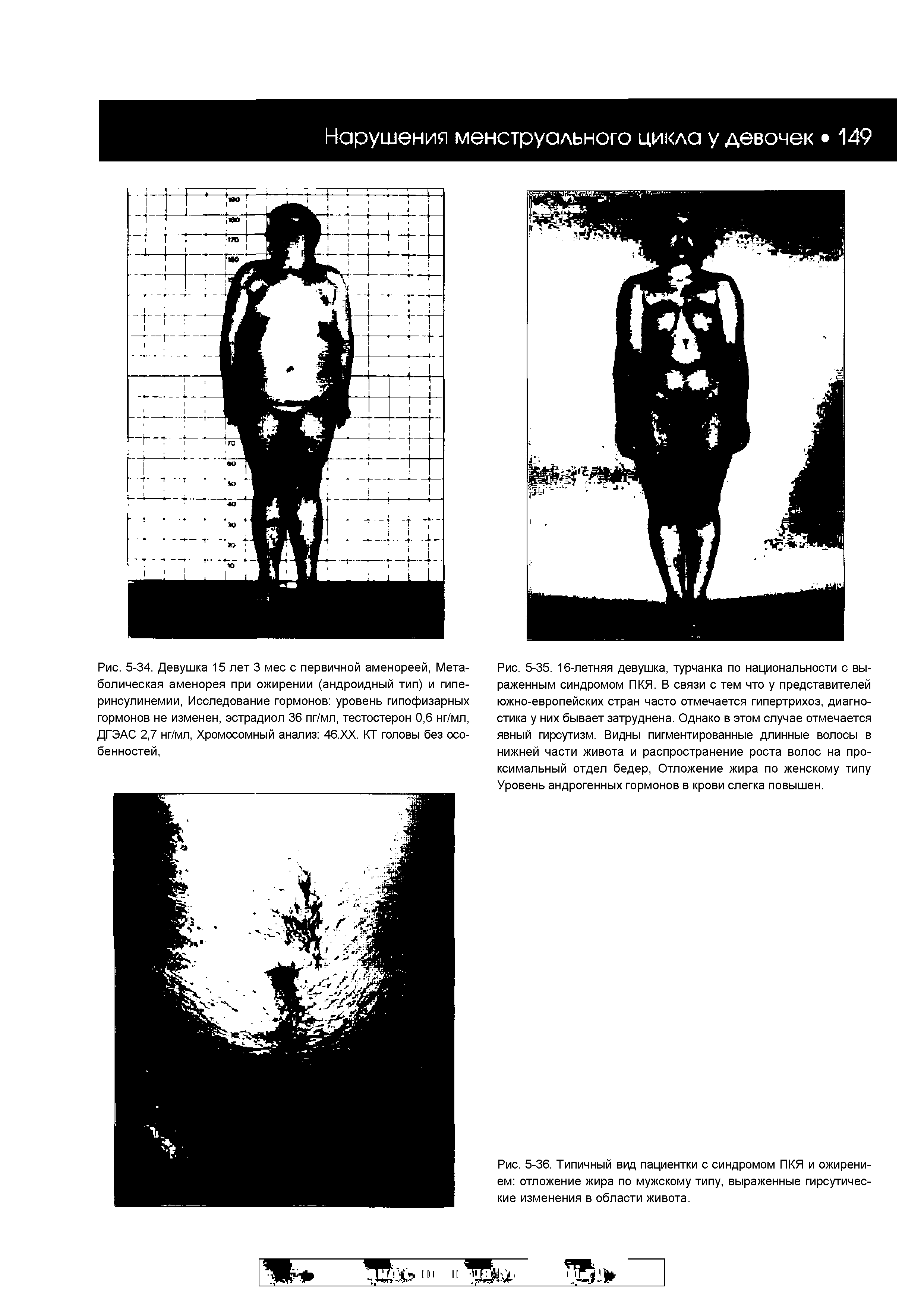 Рис. 5-34. Девушка 15 лет 3 мес с первичной аменореей, Метаболическая аменорея при ожирении (андроидный тип) и гипе-ринсулинемии, Исследование гормонов уровень гипофизарных гормонов не изменен, эстрадиол 36 пг/мл, тестостерон 0,6 нг/мл, ДГЭАС 2,7 нг/мл, Хромосомный анализ 46.ХХ. КТ головы без особенностей,...
