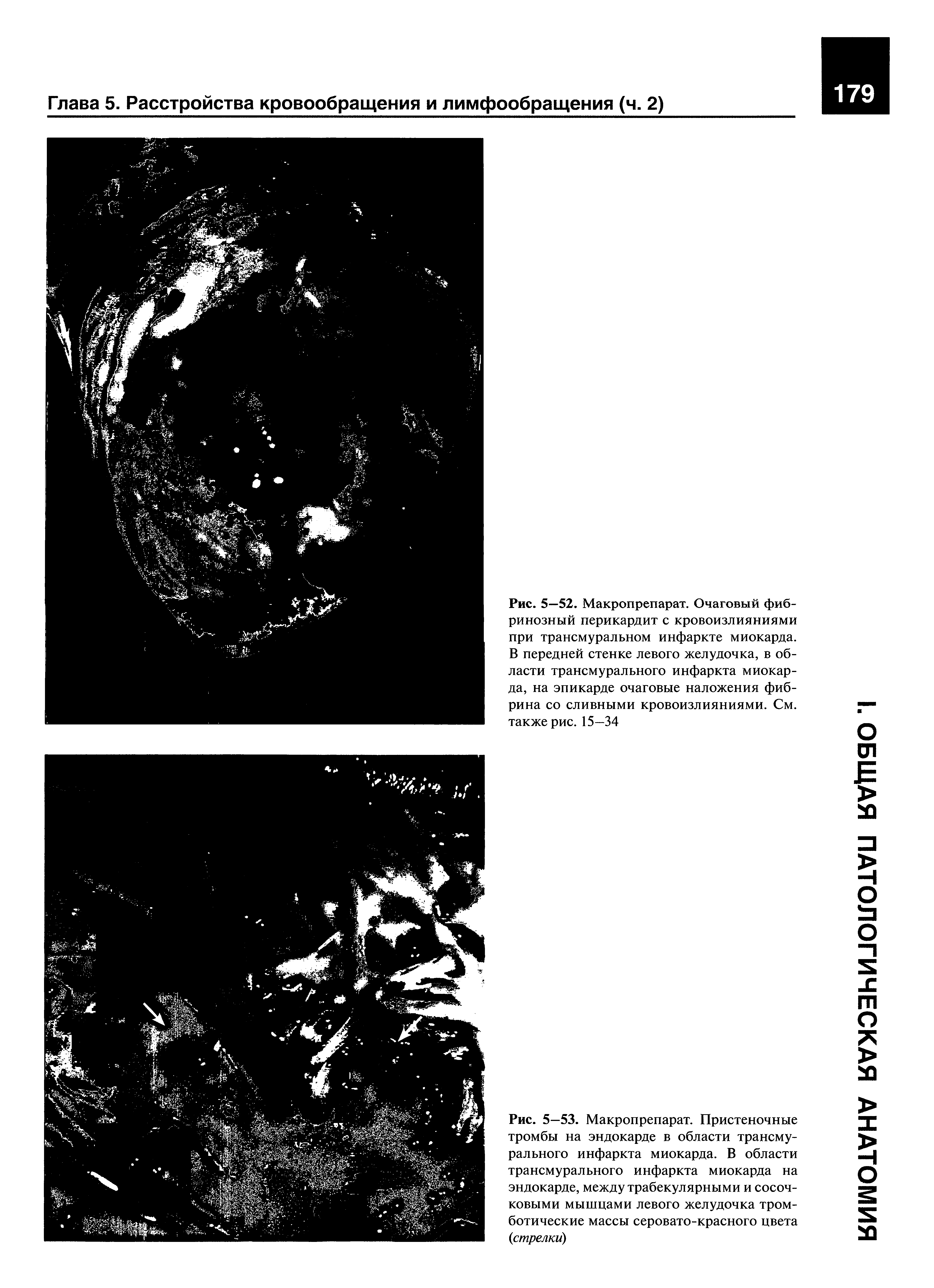 Рис. 5—52. Макропрепарат. Очаговый фибринозный перикардит с кровоизлияниями при трансмуральном инфаркте миокарда. В передней стенке левого желудочка, в области трансмурального инфаркта миокарда, на эпикарде очаговые наложения фибрина со сливными кровоизлияниями. См. также рис. 15—34...