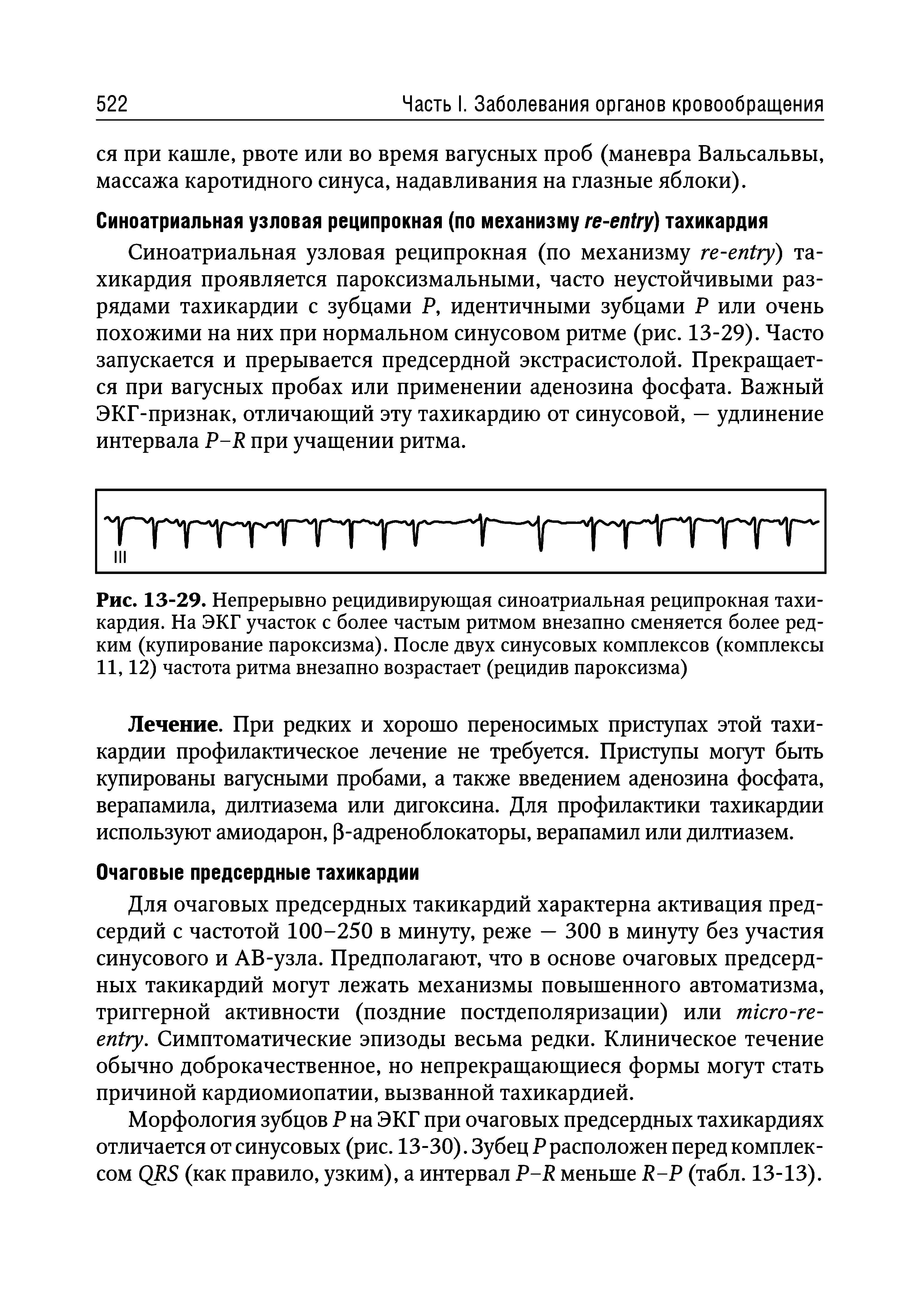 Рис. 13-29. Непрерывно рецидивирующая синоатриальная реципрокная тахикардия. На ЭКГ участок с более частым ритмом внезапно сменяется более редким (купирование пароксизма). После двух синусовых комплексов (комплексы 11,12) частота ритма внезапно возрастает (рецидив пароксизма)...