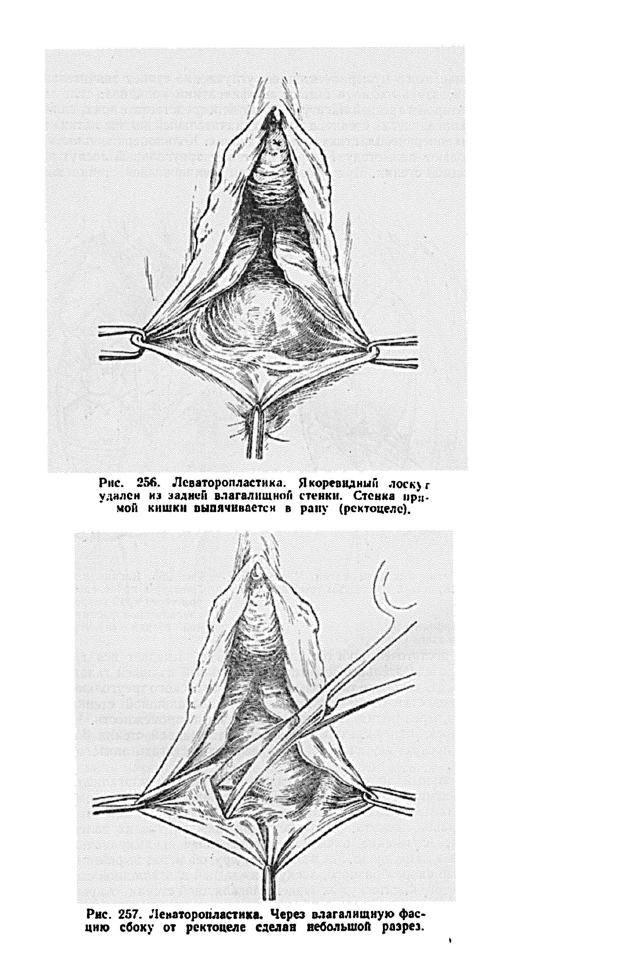 Рис. 257. Ленаторопластнка. Через влагалищную фасцию сбоку от ректоцеле сделан небольшой разрез.