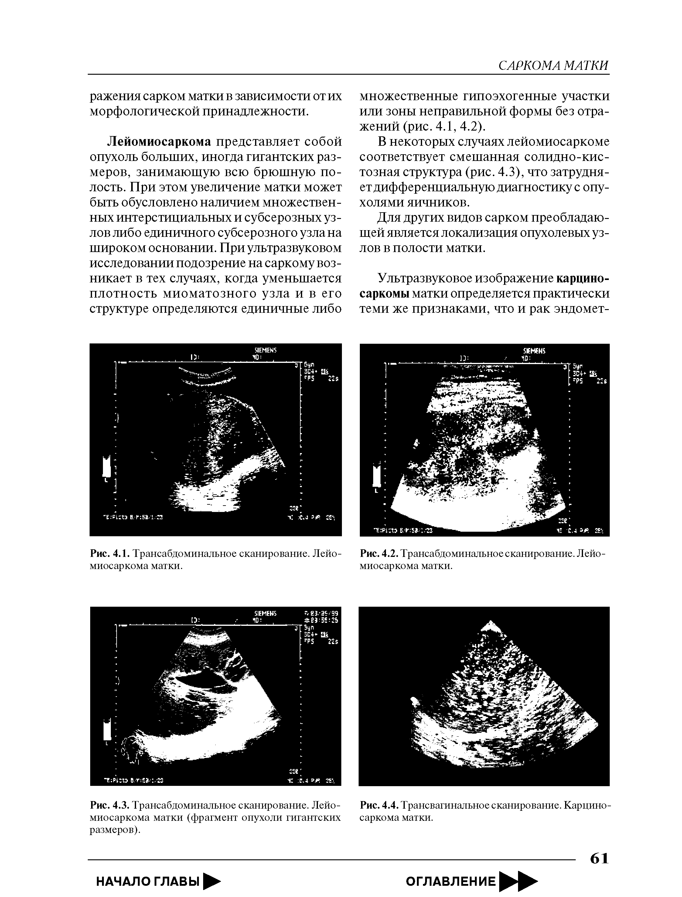 Рис. 4.3. Трансабдоминальное сканирование. Лейомиосаркома матки (фрагмент опухоли гигантских размеров).