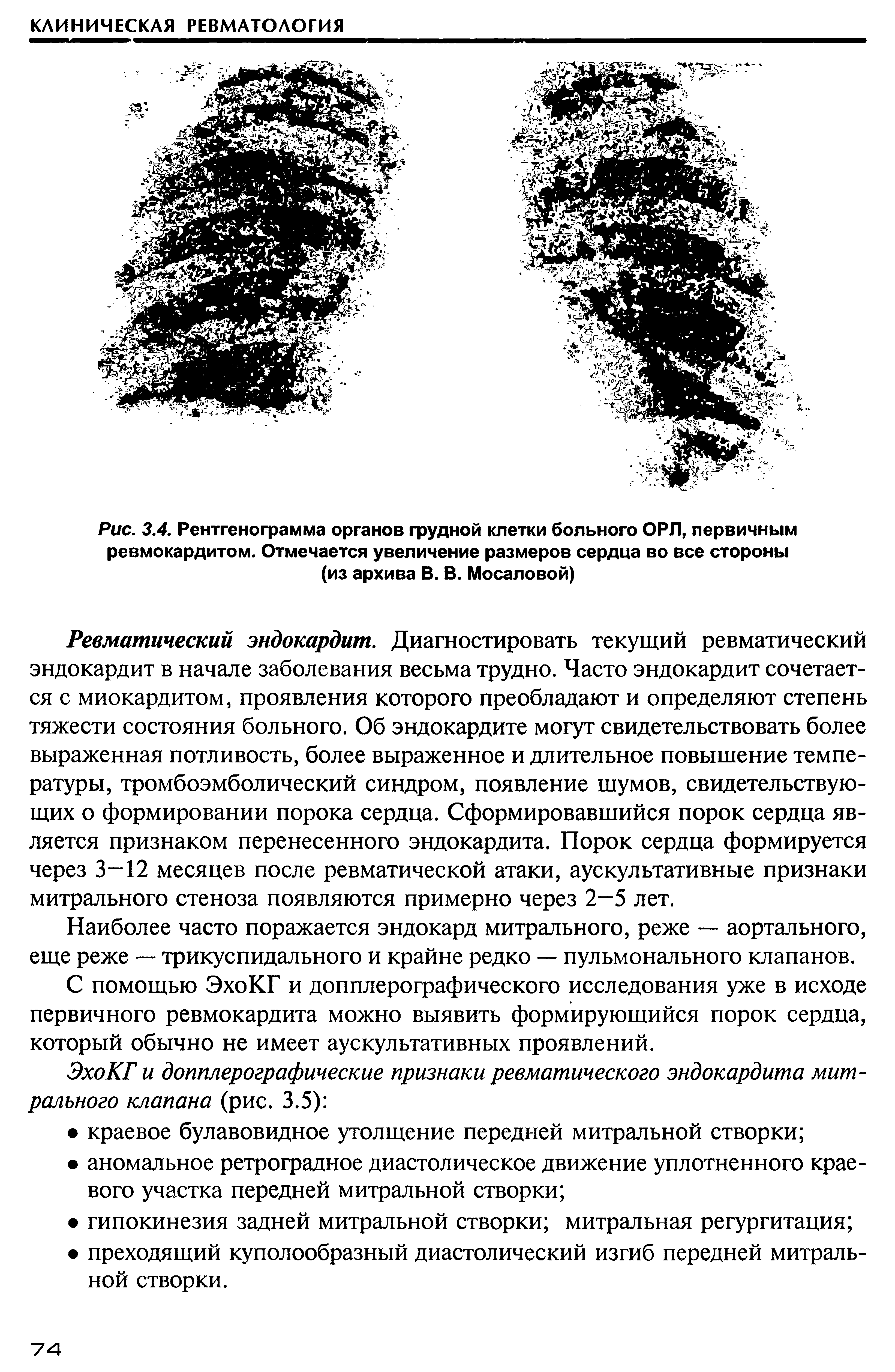 Рис. 3.4. Рентгенограмма органов грудной клетки больного ОРП, первичным ревмокардитом. Отмечается увеличение размеров сердца во все стороны (из архива В. В. Мосаловой)...