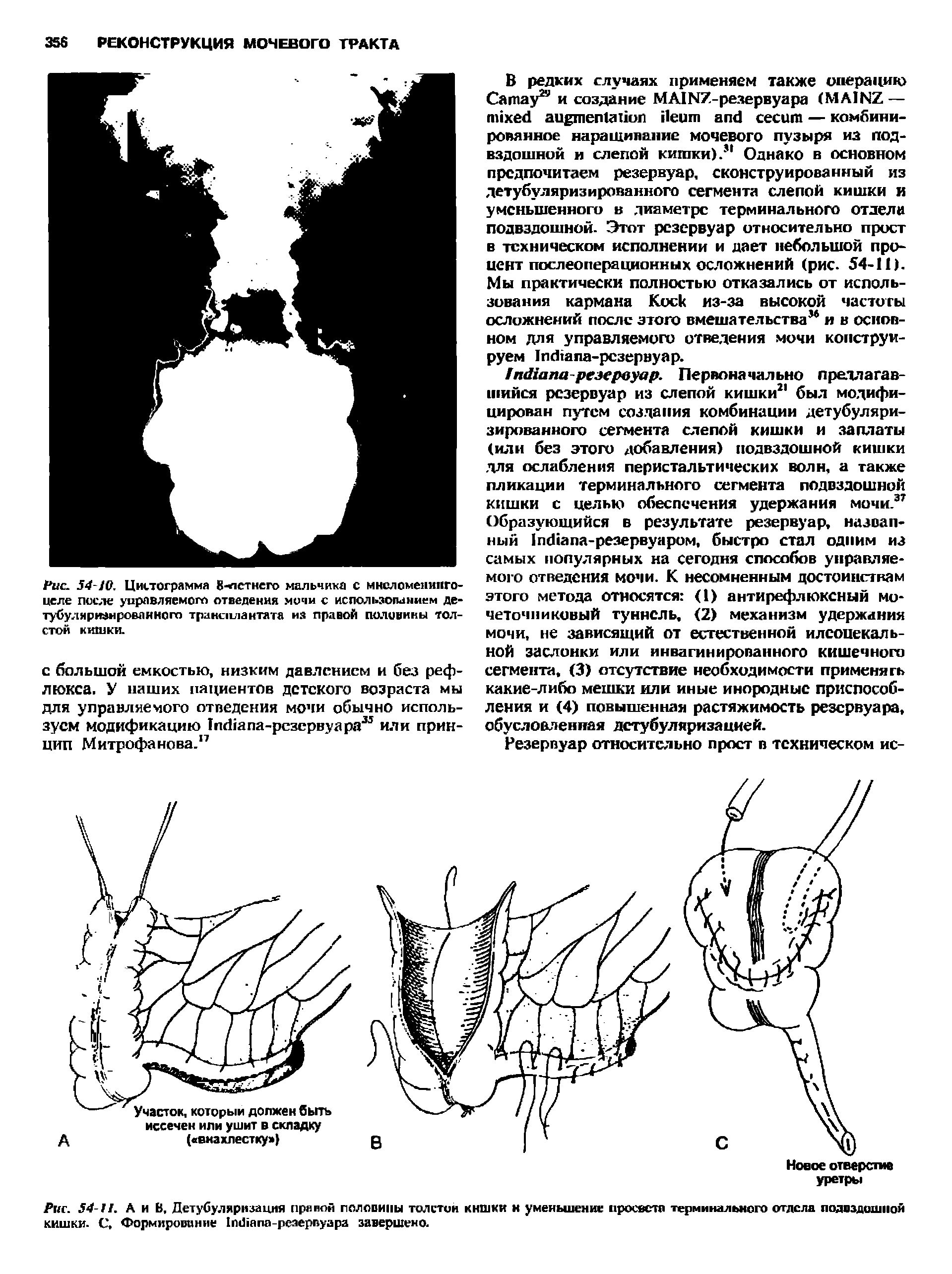 Рис. 54-11. А и В, Детубуляризация праной половины толстой кишки и уменьшение просвета терминального отдела подвздошной кишки. С, Формирование 1тЯапа-ре №рвуара завершено.