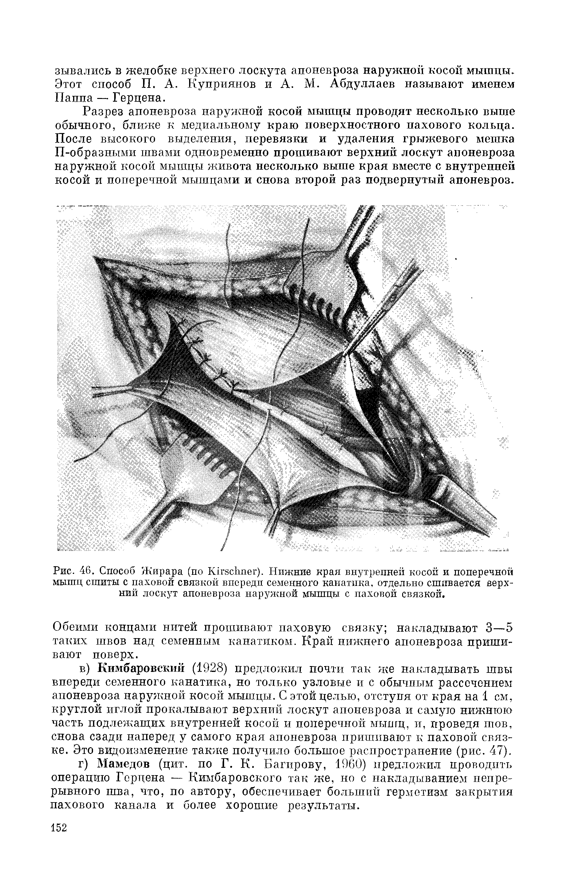 Рис. 46. Способ Жирара (по K ). Нижние края внутренней косой и поперечной мышц сшиты с паховой связкой впереди семенного канатика, отдельно сшивается верхний лоскут апоневроза наружной мышцы с паховой связкой.