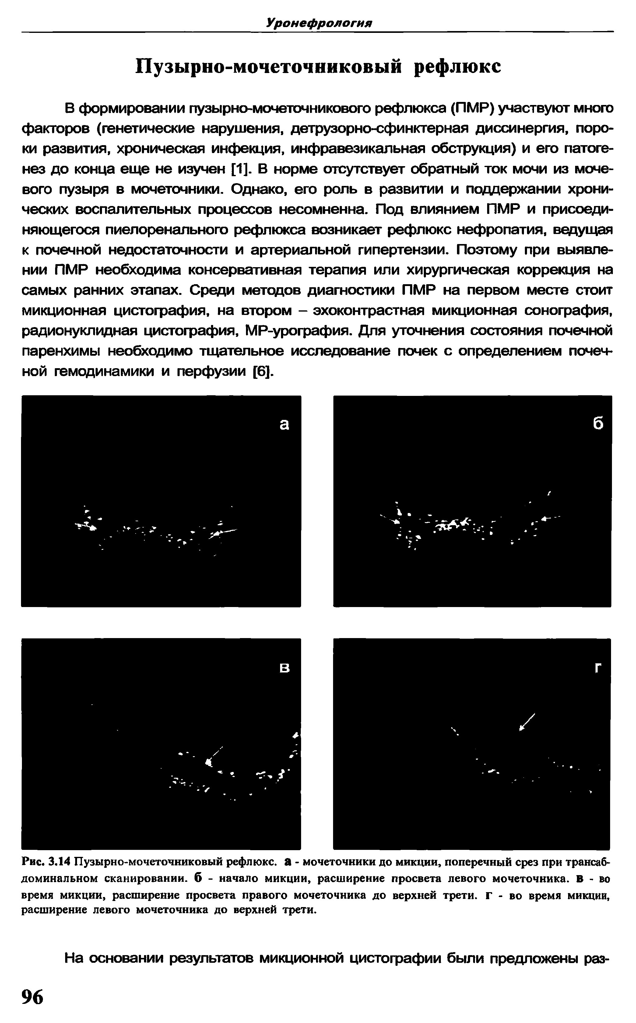 Рис. 3.14 Пузырно-мочеточниковый рефлюкс, а - мочеточники до микции, поперечный срез при трансабдоминальном сканировании, б - начало микции, расширение просвета левого мочеточника. В-во время микции, расширение просвета правого мочеточника до верхней трети, г - во время микции, расширение левого мочеточника до верхней трети.