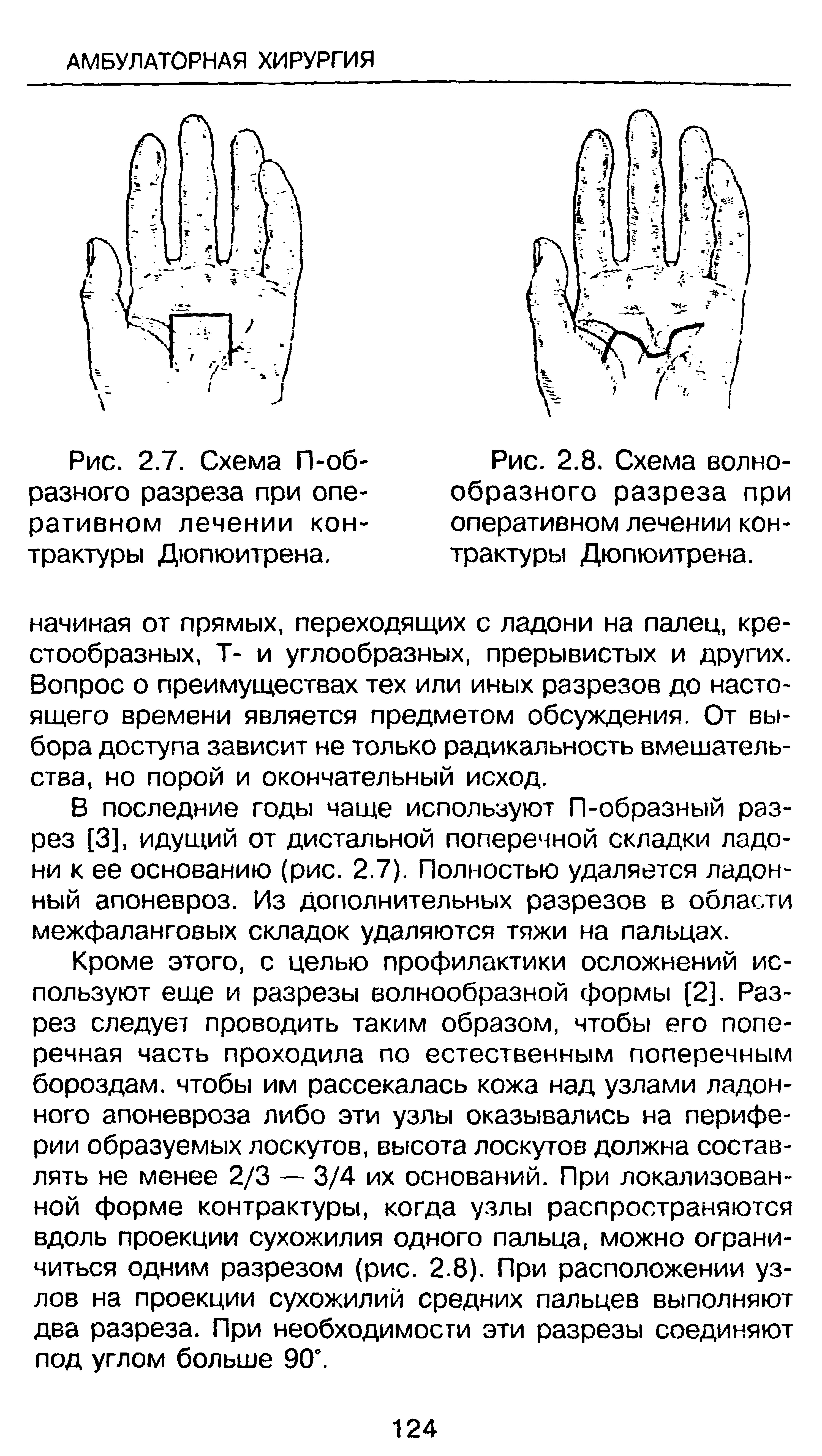 Рис. 2.7. Схема П-об-разного разреза при оперативном лечении контрактуры Дюпюитрена.