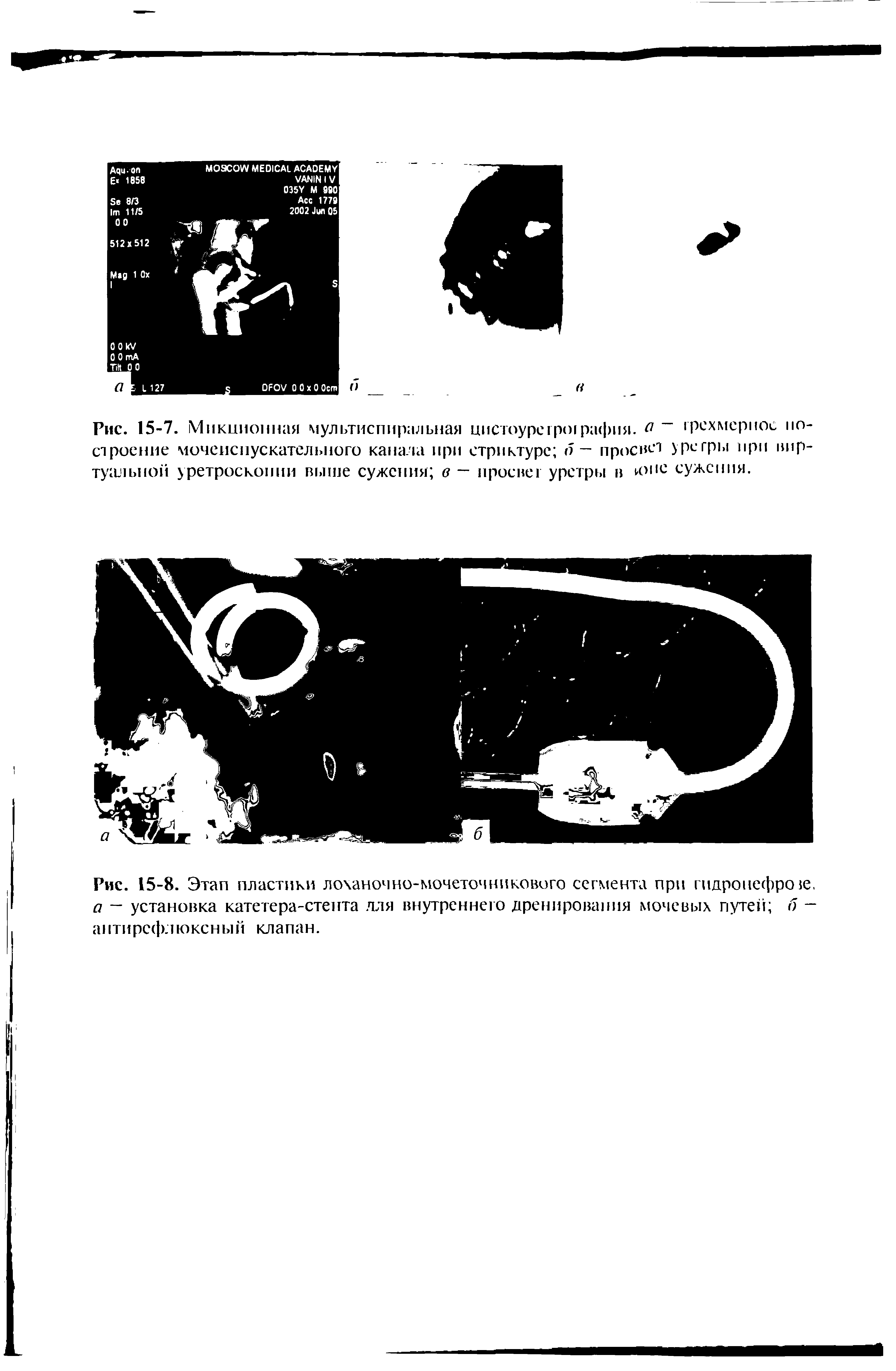 Рис. 15-8. Этап пластики лоханочно-мочеточникового сегмента при гидронефрозе. а — установка катетера-стента лля внутреннего дренирования мочевых путей б -антирсфлюксный клапан.