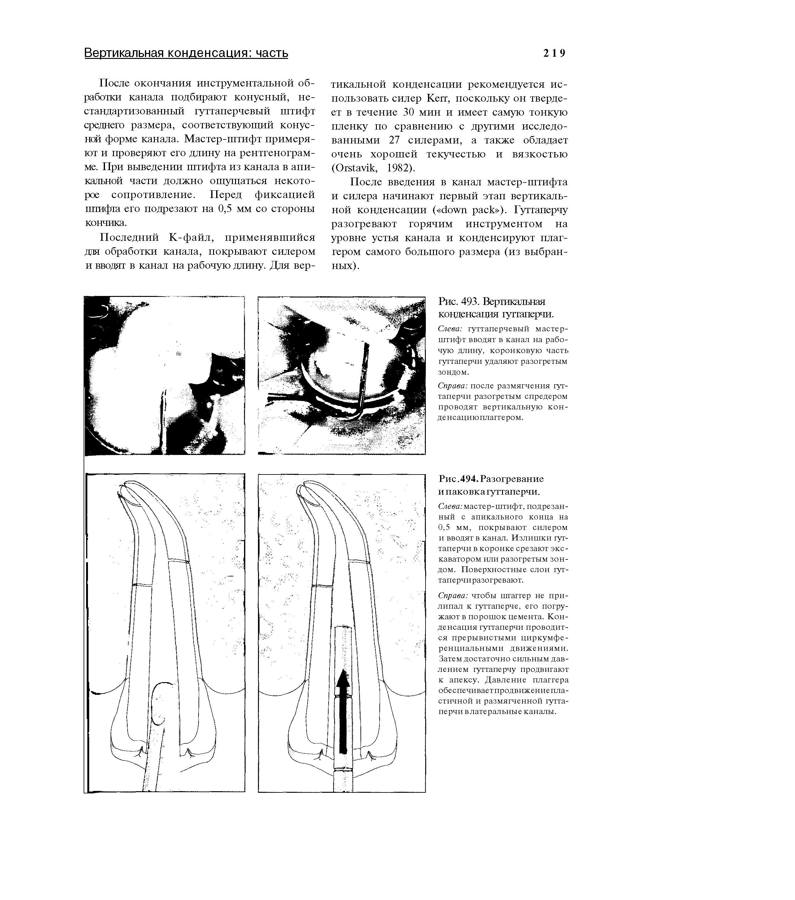 Рис. 493. Вертикальная конденсация гуттаперчи. Слева гуттаперчевый мастер-штифт вводят в канал на рабочую длину, коронковую часть гуттаперчи удаляют разогретым зондом.