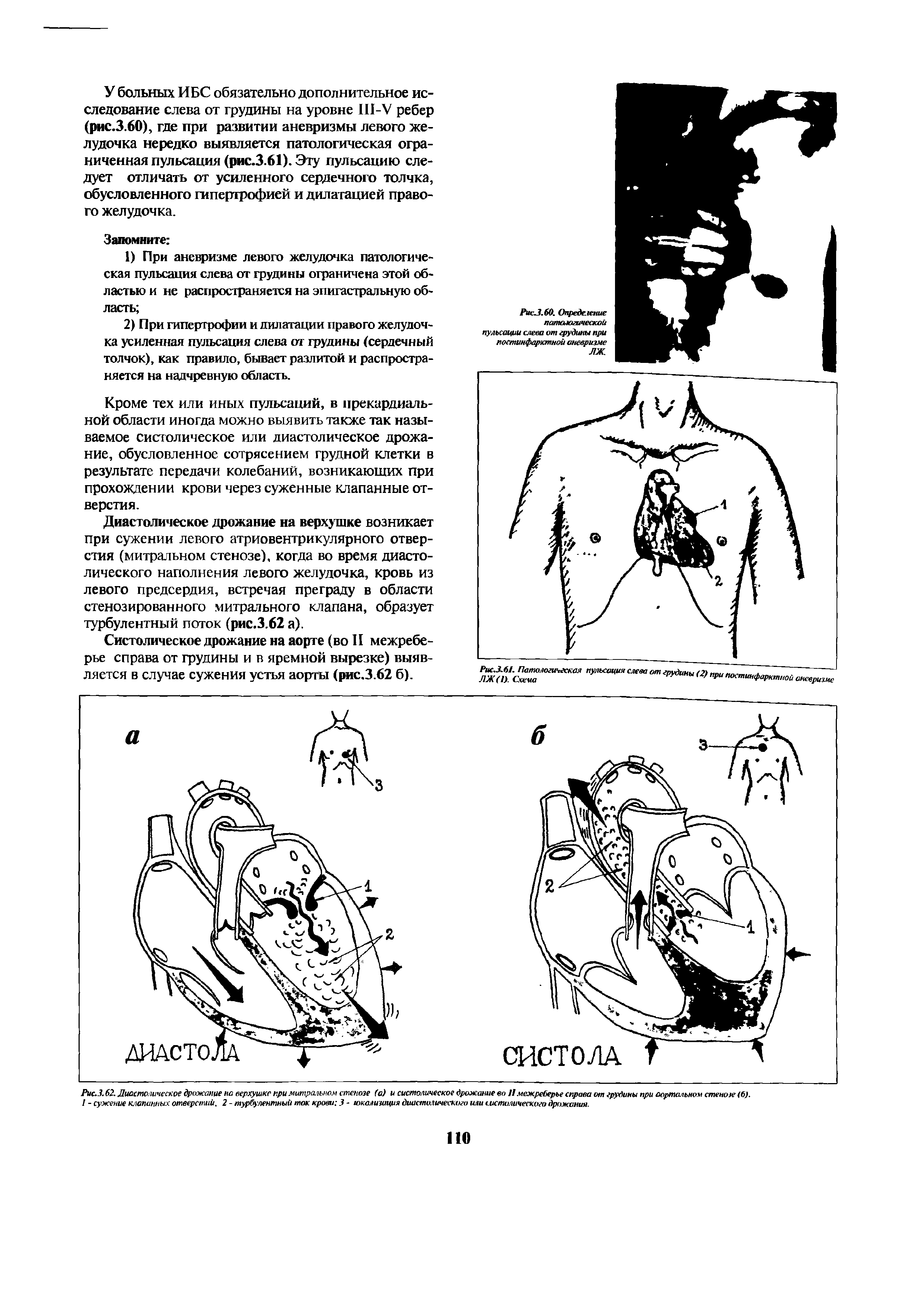 Рис.3.62. Диастолическое дрожание на верхушке при митральном стенозе (а) и систолическое дрожание во 11 межреберье справа от грудины при аортальном стенозе (б). 1 - сужение клапанных отверстии. 2 - турбулентный ток крови 3 - юкализиция диастолического или систолического дрожания.