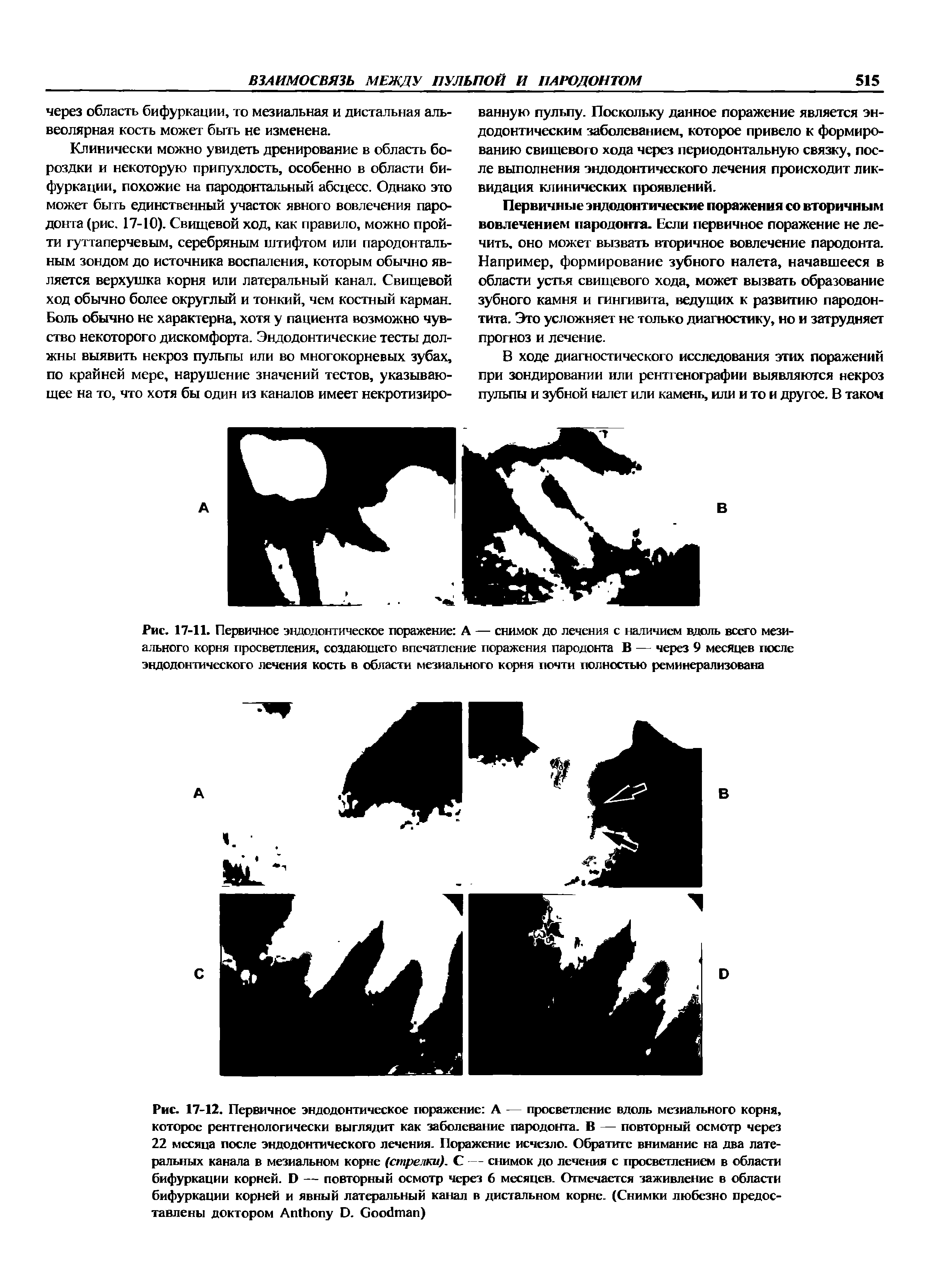 Рис. 17-11. Первичное эндодонтическое поражение А — снимок до лечения с наличием вдоль всего мезиального корня просветления, создающего впечатление поражения пародонта В — через 9 месяцев после эндодонтического лечения кость в области мезиального корня почти полностью реминерализована...