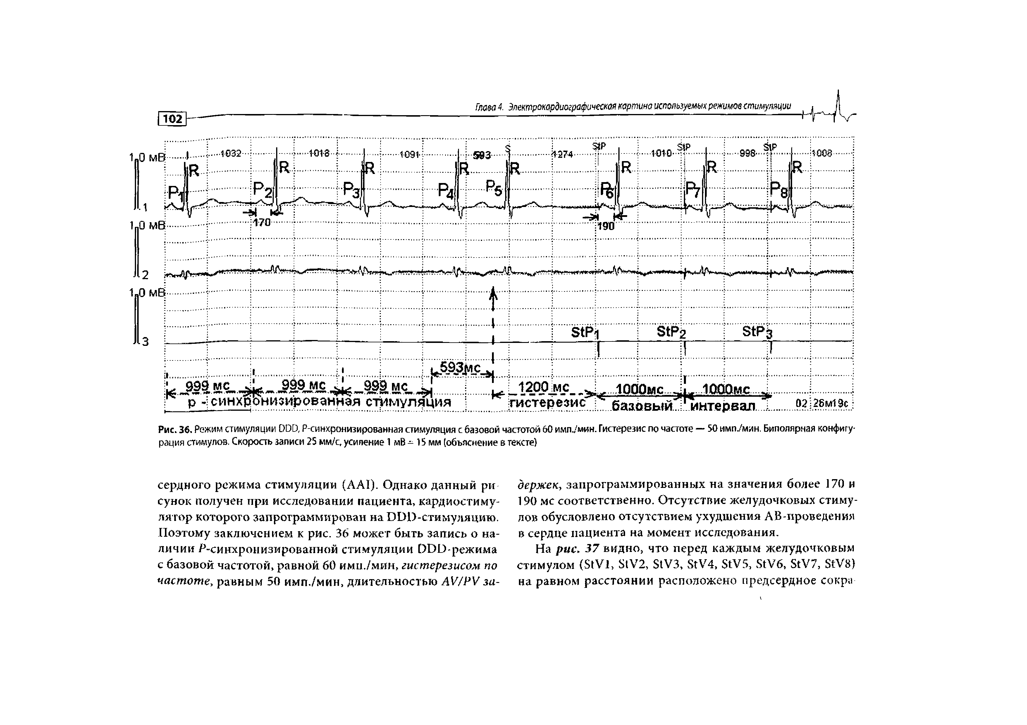 Рис. 36. Режим стимуляции ООО, Р-синхронизированная стимуляция с базовой частотой 60 имп./мин. Гистерезис по частоте — 50 имп./мин. Биполярная конфигурация стимулов. Скорость записи 25 мм/с, усиление 1 мВ - 15 мм (объяснение в тексте)...