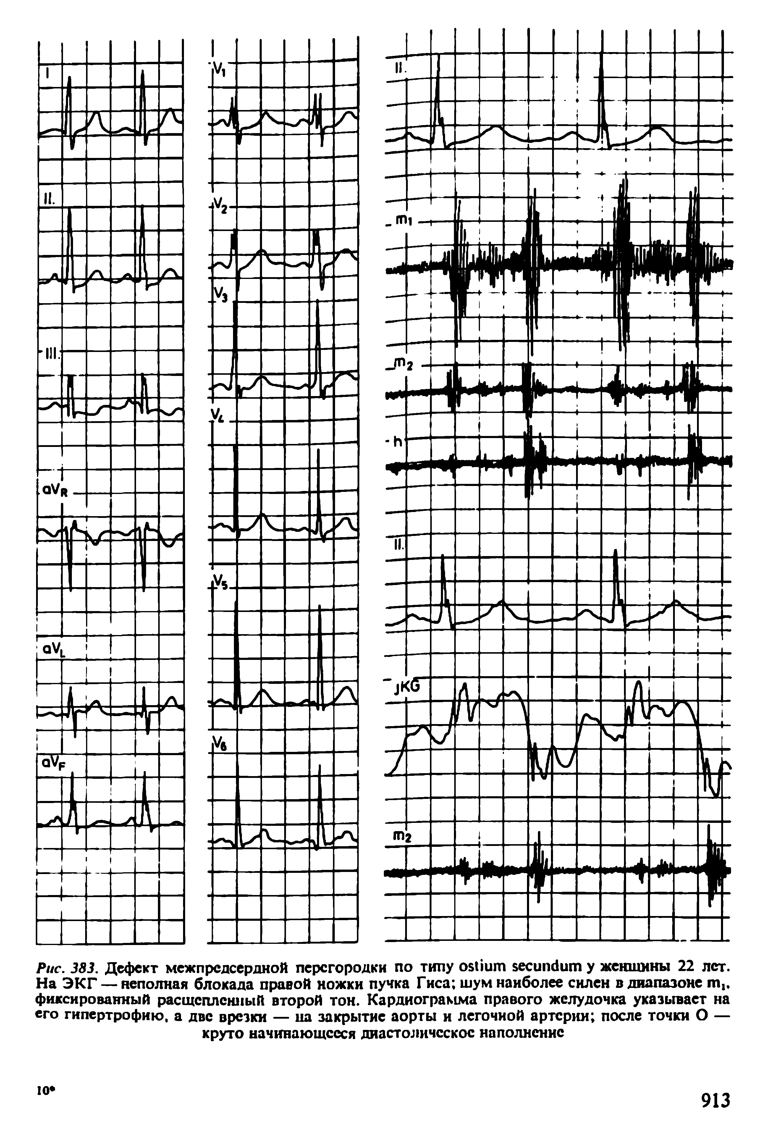 Рис. 383. Дефект межпредсердной перегородки по типу у женщины 22 лет. На ЭКГ — неполная блокада правой ножки пучка Гиса шум наиболее силен в диапазоне фиксированный расщепленный второй тон. Кардиограмма правого желудочка указывает на его гипертрофию, а две врезки — на закрытие аорты и легочной артерии после точки О — круто начинающееся диастолическое наполнение...
