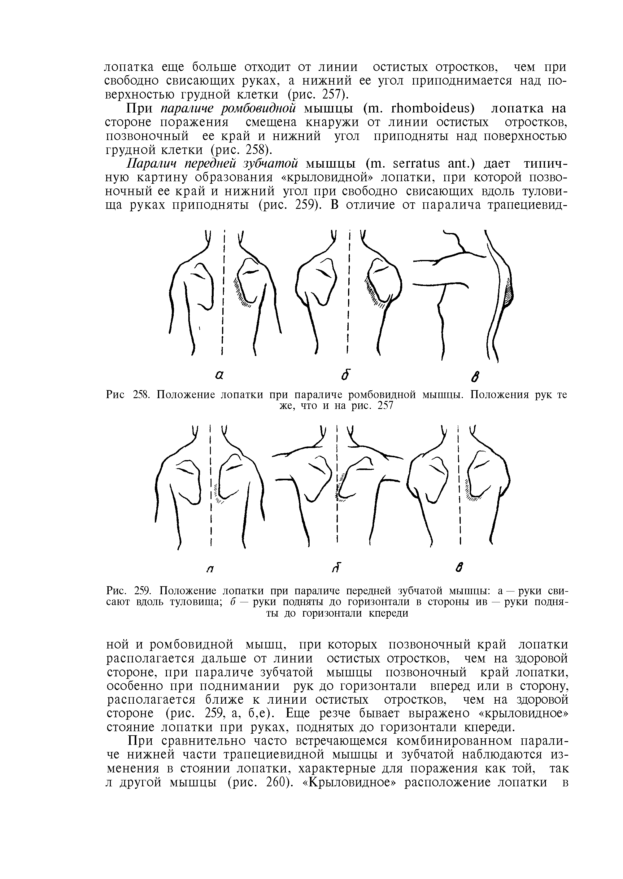 Рис. 259. Положение лопатки при параличе передней зубчатой мышцы а — руки свисают вдоль туловища б — руки подняты до горизонтали в стороны ив — руки подняты до горизонтали кпереди...