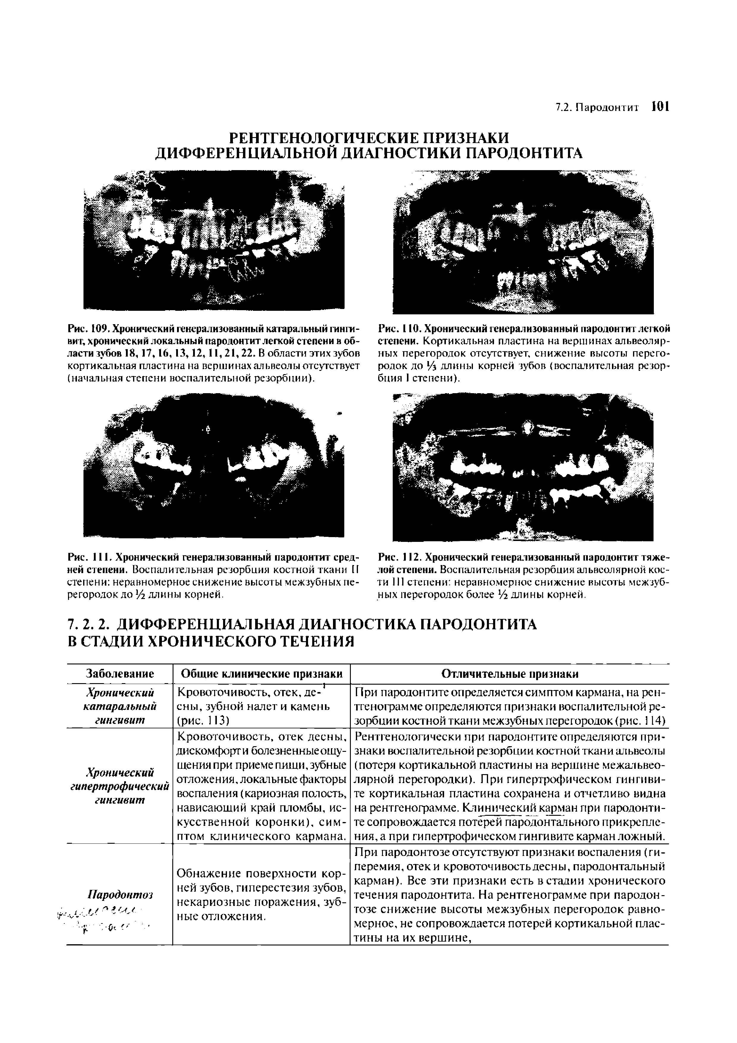 Рис. 109. Хронический генерализованный катаральный гингивит, хронический локальный пародонтит легкой степени в области зубов 18,17,16, 13,12,11,21, 22. В области этих зубов кортикальная пластина на вершинах альвеолы отсутствует (начальная степени воспалительной резорбции).