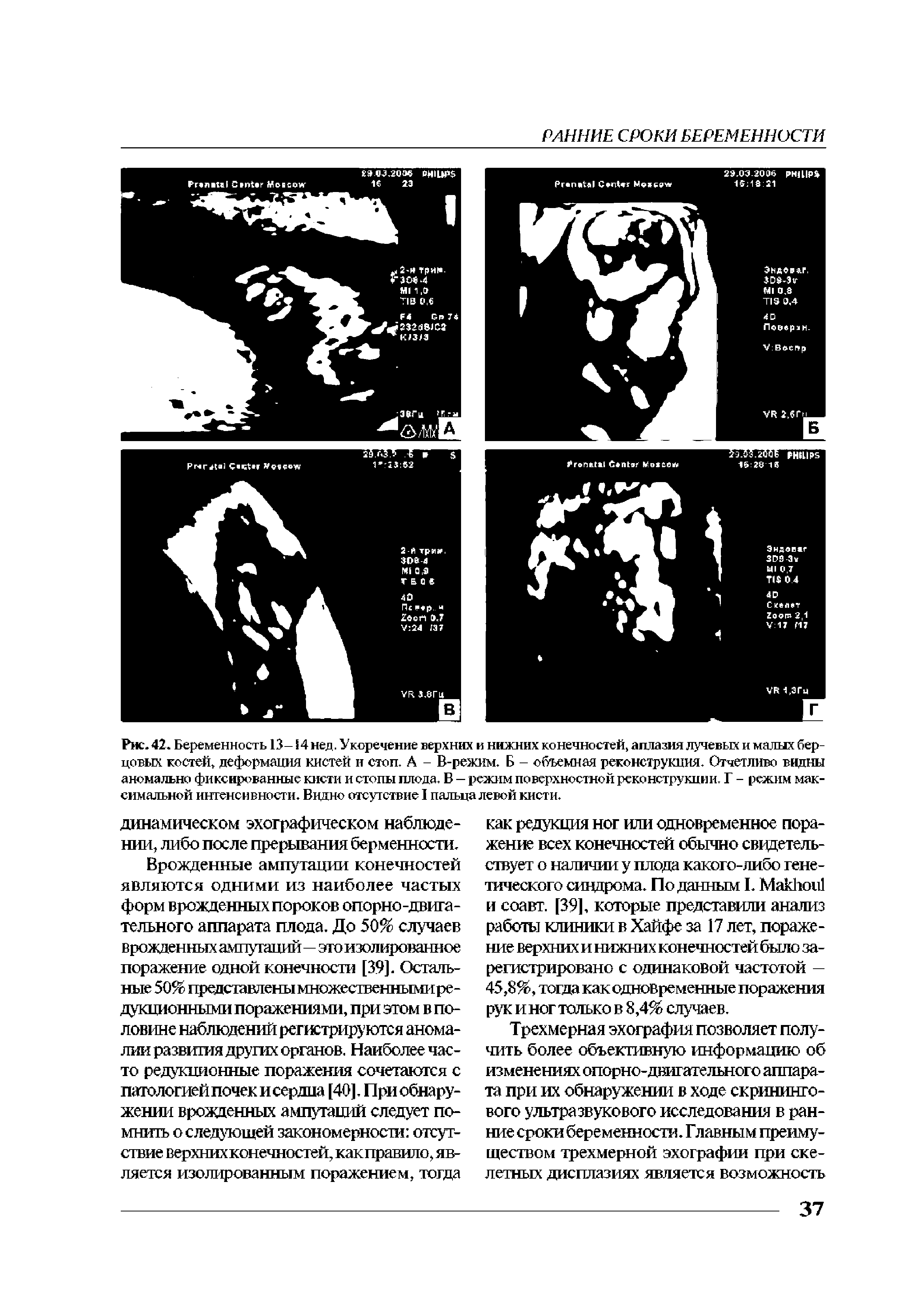 Рис. 42. Беременность 13- 4нед. Укоренение верхних и нижних конечностей, аплазия лучевых и малых берцовых костей, деформация кистей и стоп. А - В-режим. Б - объемная реконструкция. Отчетливо видны аномально фиксированные кисти и стопы плода. В — режим поверхностной реконструкции, Г - режим максимальной интенсивности. Видно отсутствие I пальца левой кисти.