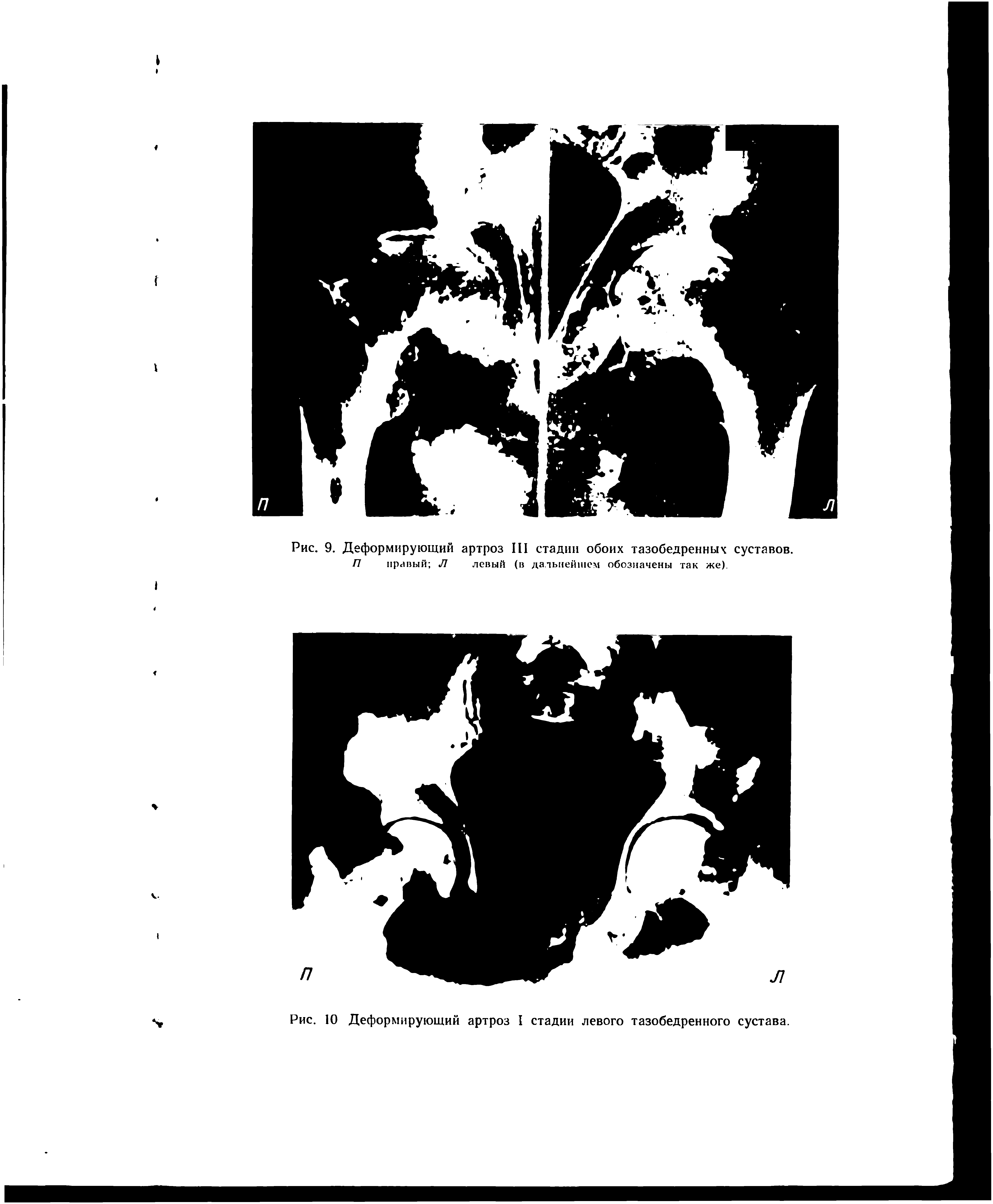 Рис. 9. Деформирующий артроз III стадии обоих тазобедренных суставов. П правый Л левый (в дальнейшем обозначены так же).