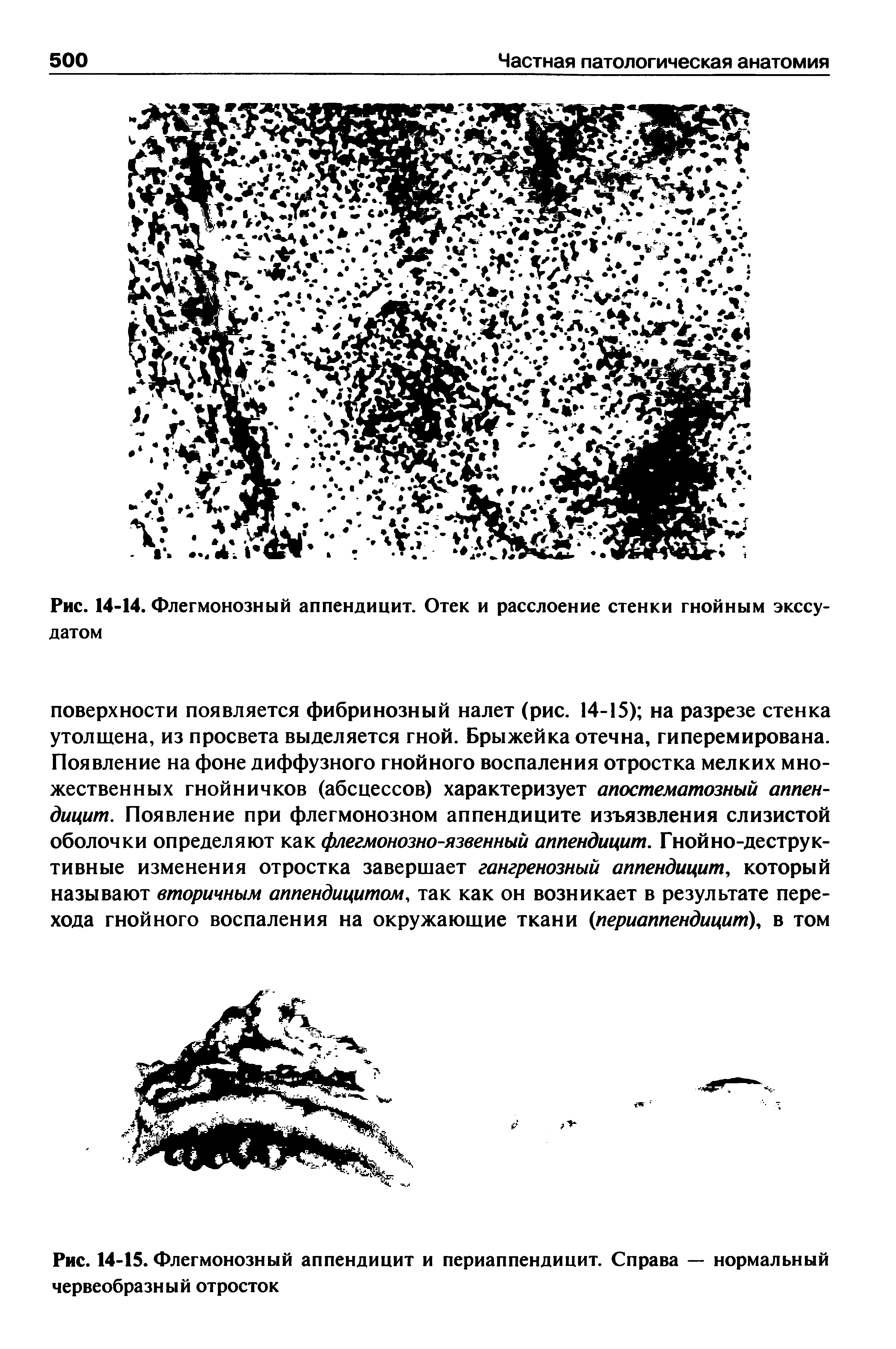 Рис. 14-15. Флегмонозный аппендицит и периаппендицит. Справа — нормальный червеобразный отросток...